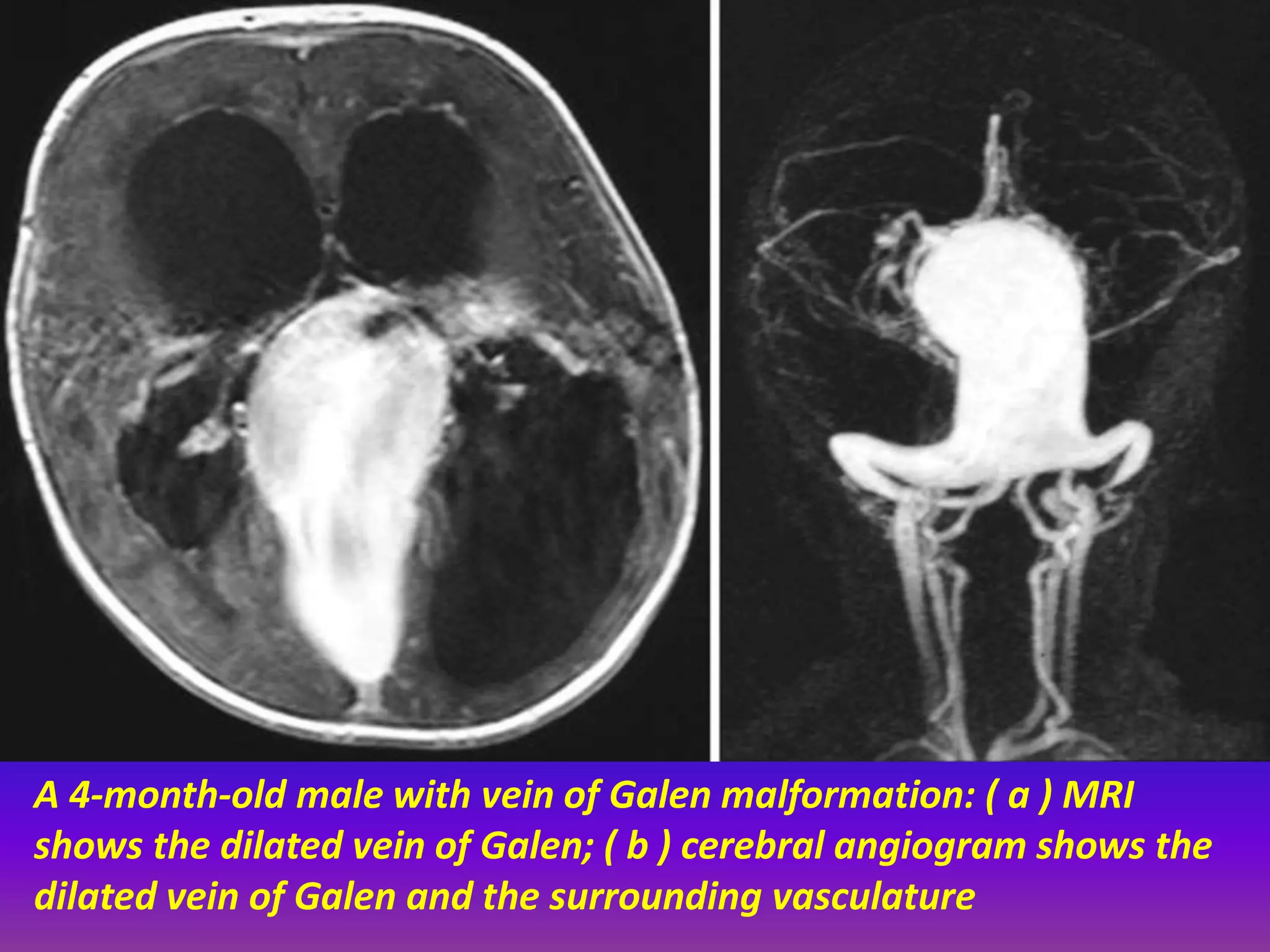 A 4-month-old male with vein of Galen malformation: ( a ) MRI 
shows the dilated vein of Galen; ( b ) cerebral angiogram shows the 
dilated vein of Galen and the surrounding vasculature 
 