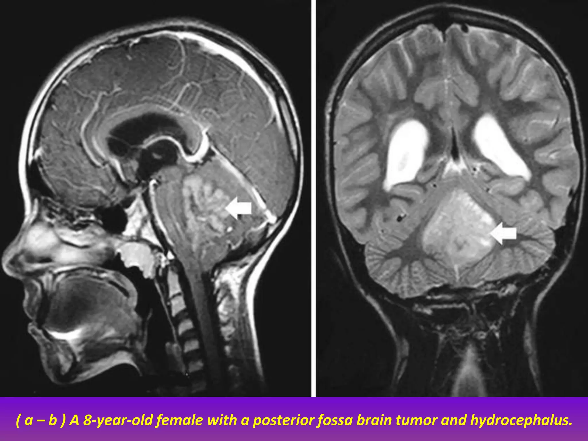 ( a – b ) A 8-year-old female with a posterior fossa brain tumor and hydrocephalus. 
 