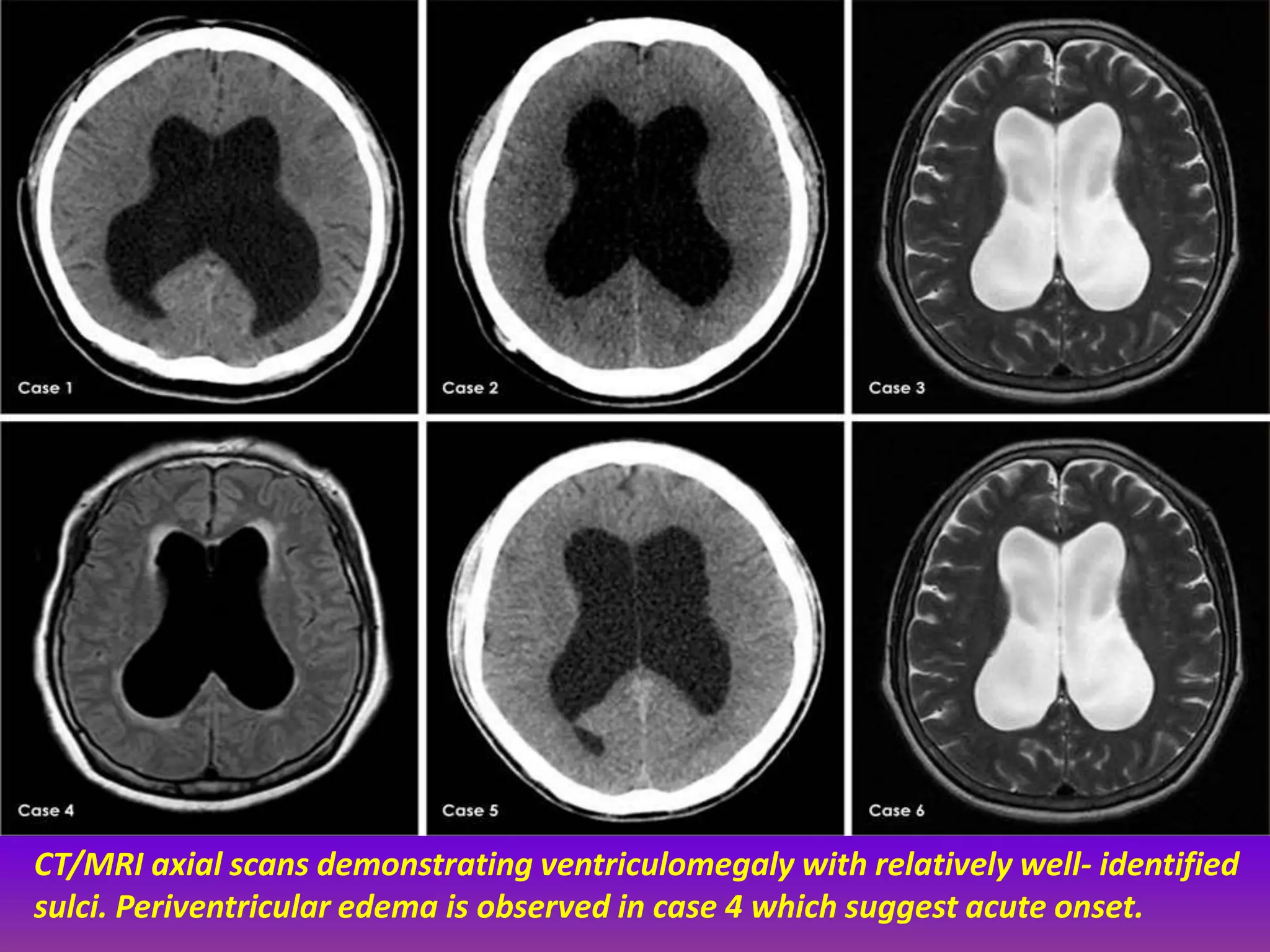 CT/MRI axial scans demonstrating ventriculomegaly with relatively well- identified 
sulci. Periventricular edema is observed in case 4 which suggest acute onset. 
 