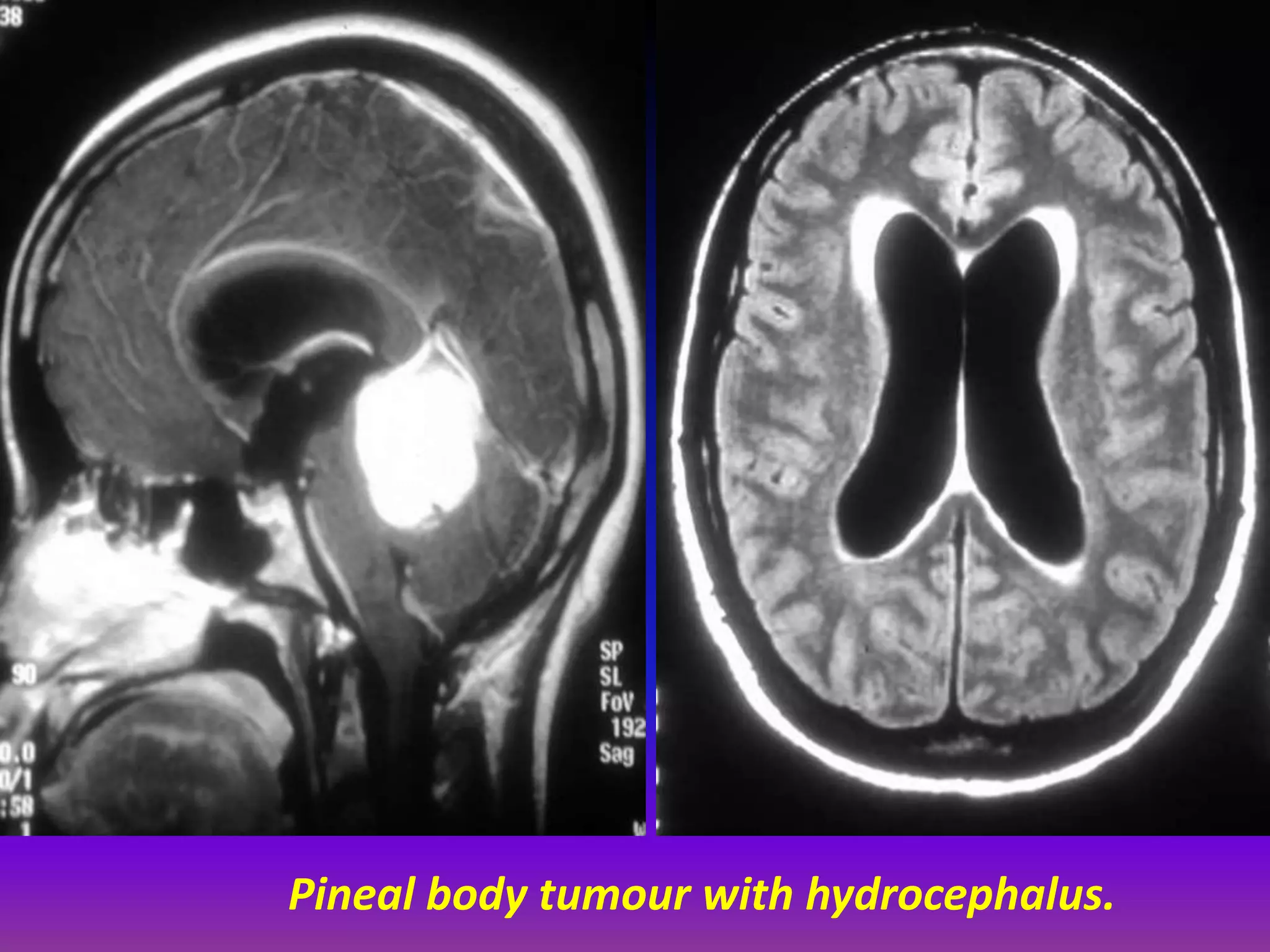 Pineal body tumour with hydrocephalus. 
 