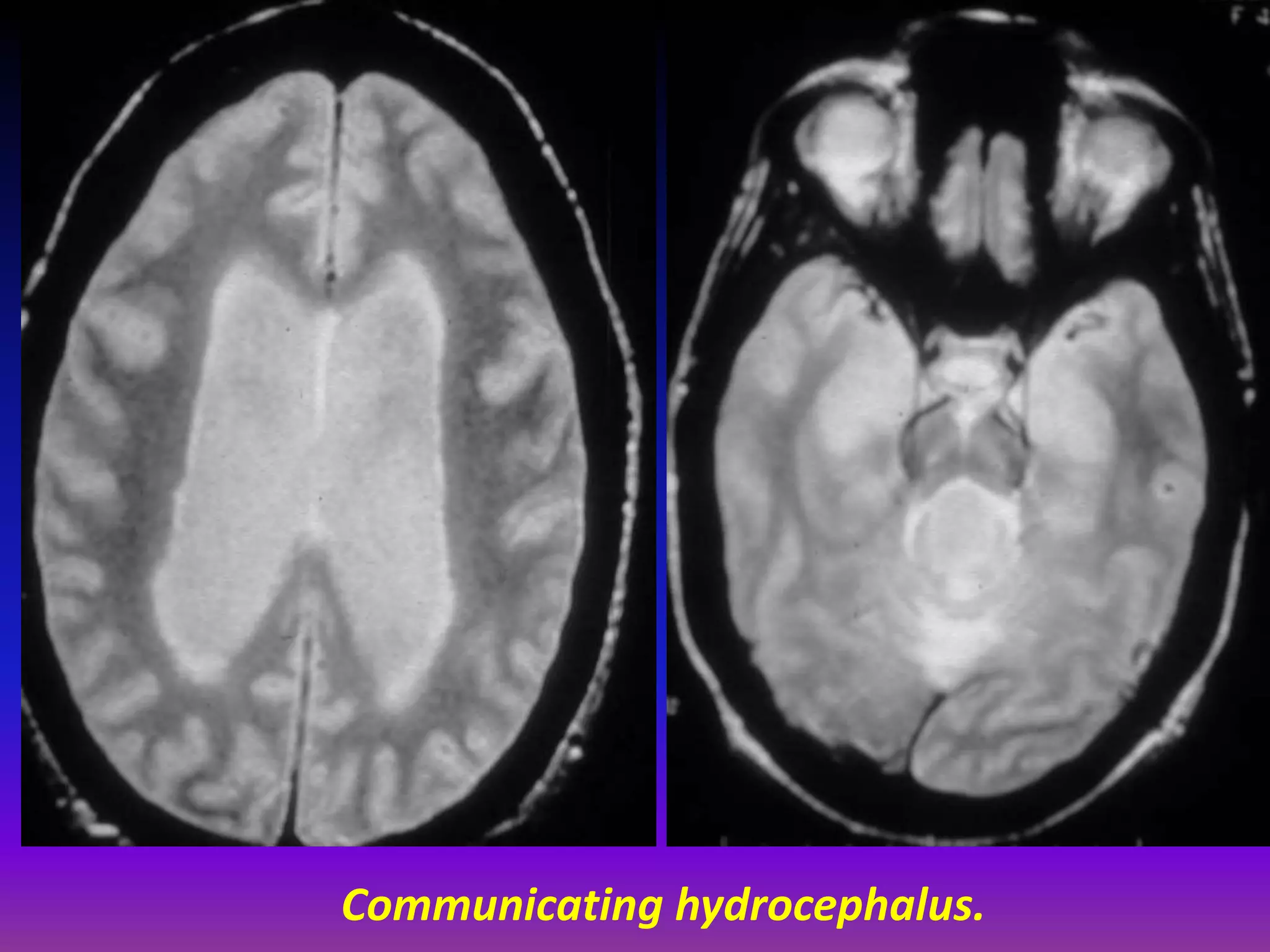 Communicating hydrocephalus. 
 