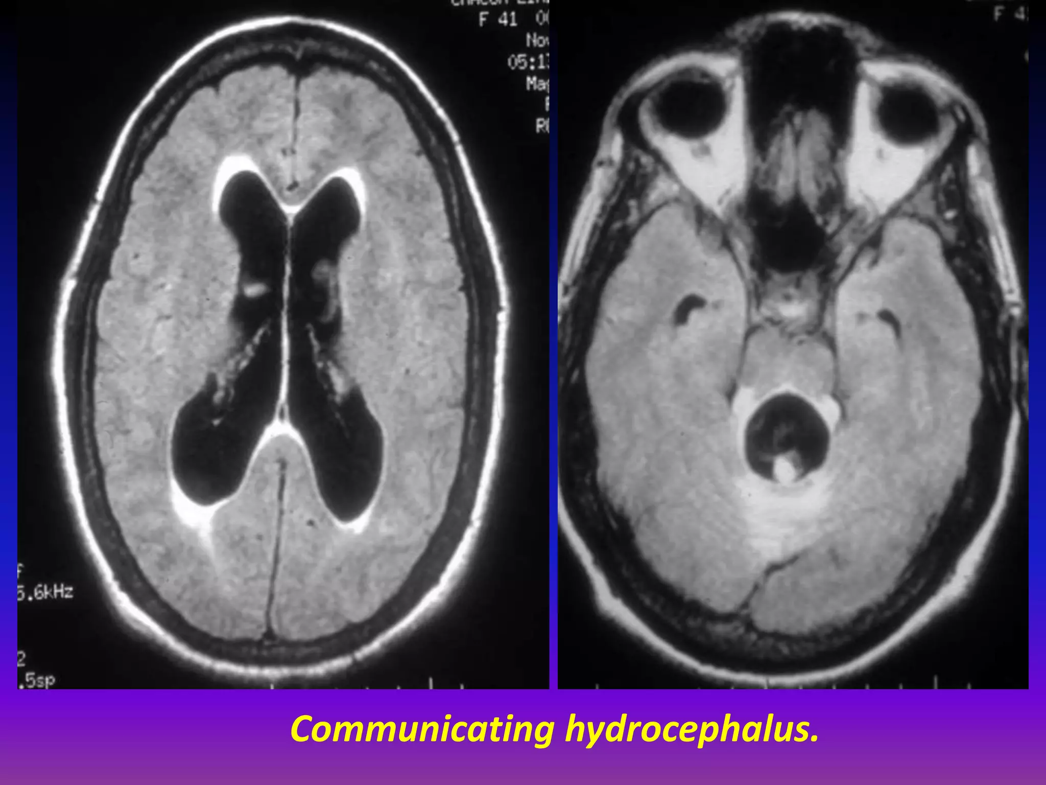 Communicating hydrocephalus. 
 