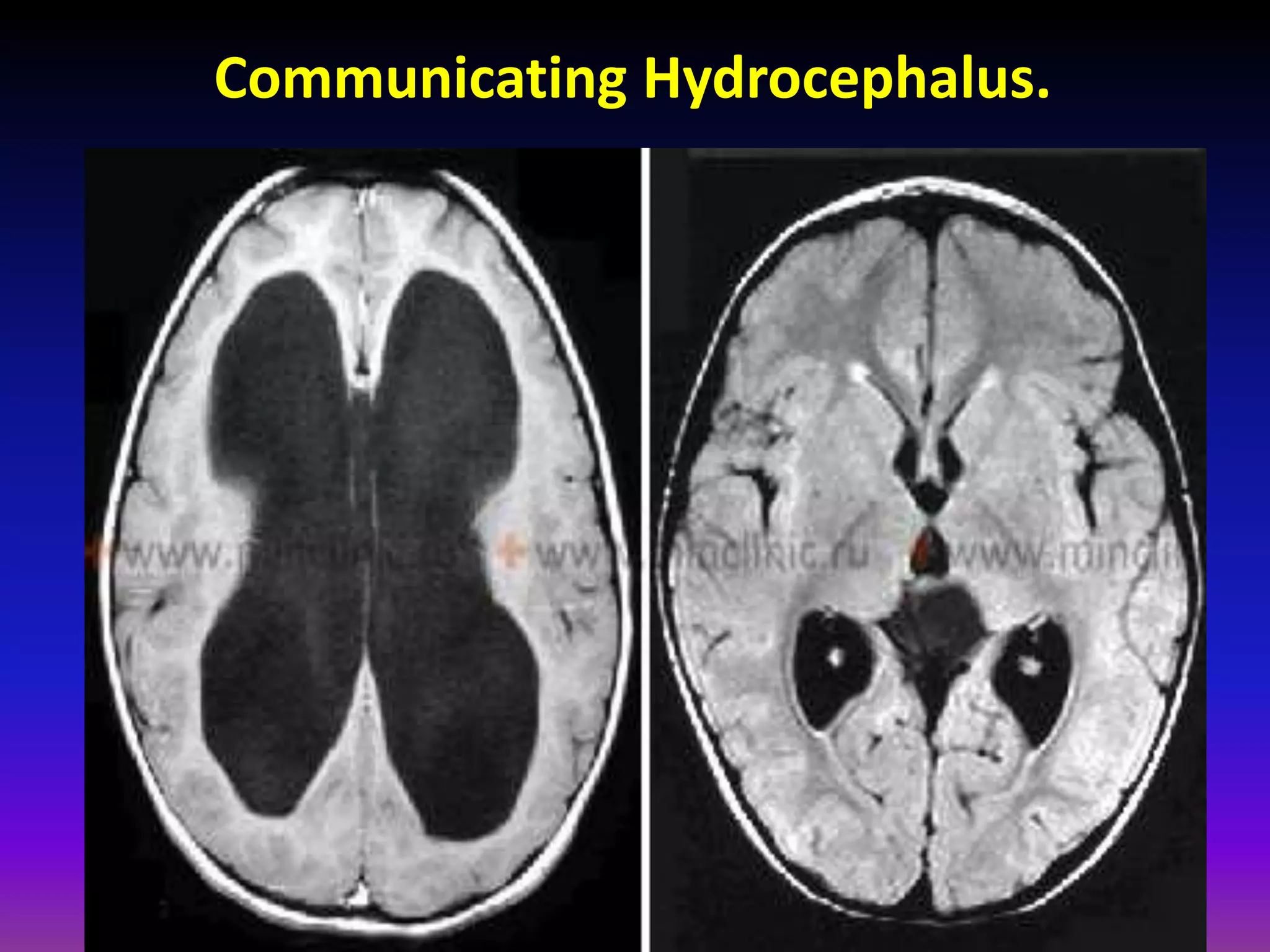 Communicating Hydrocephalus. 
 