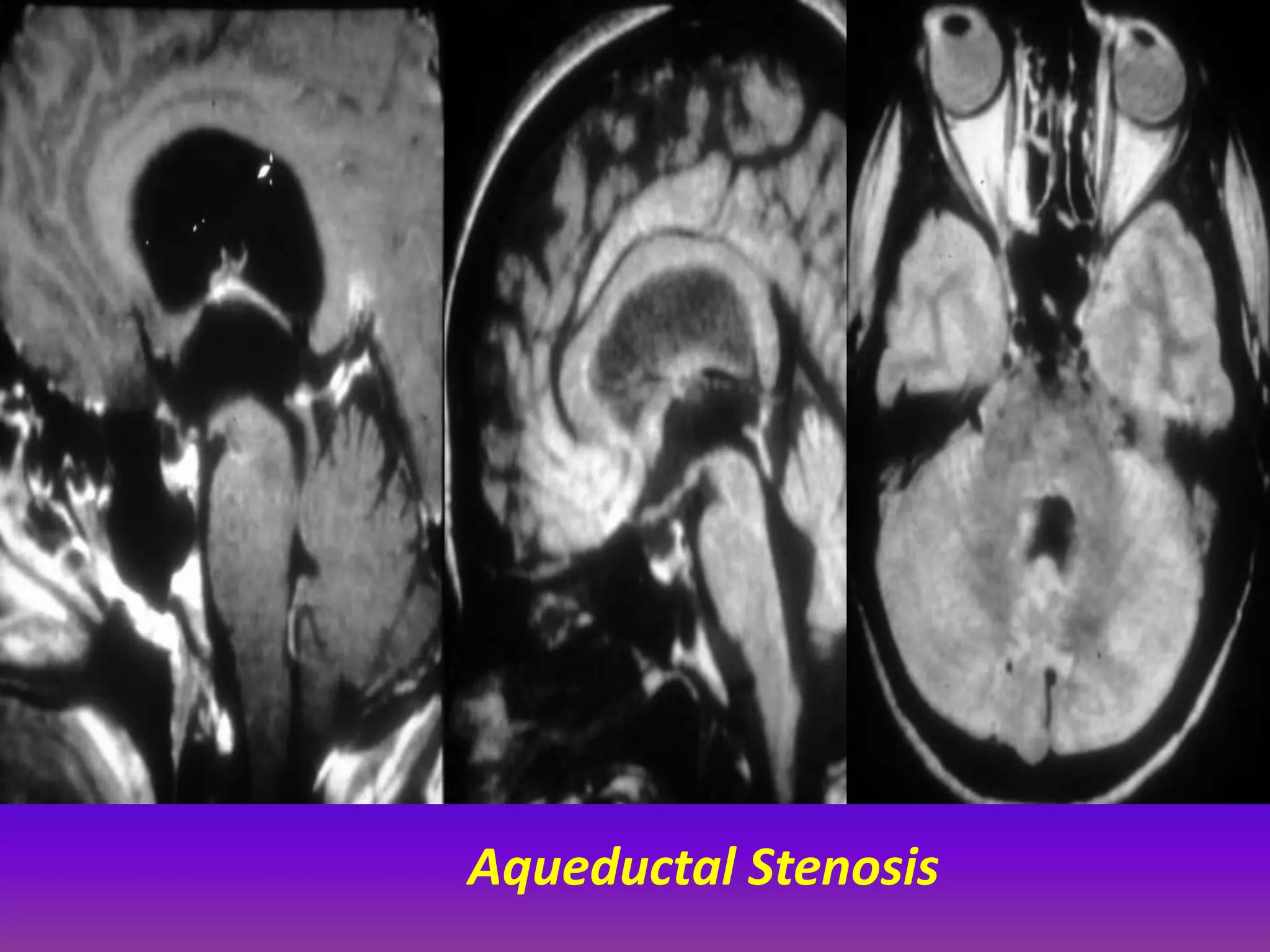 Aqueductal Stenosis 
 