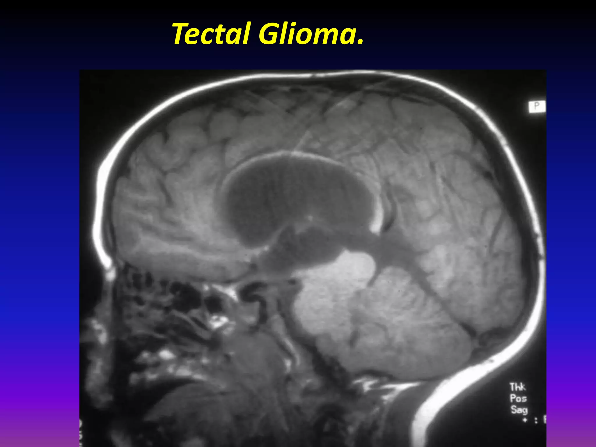 Tectal Glioma. 
 