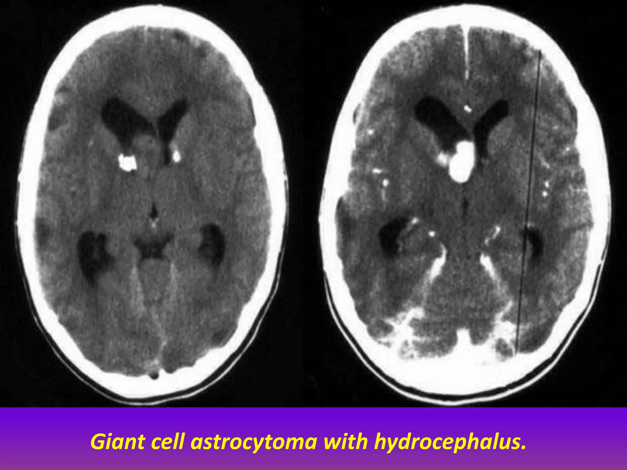 Giant cell astrocytoma with hydrocephalus. 
 