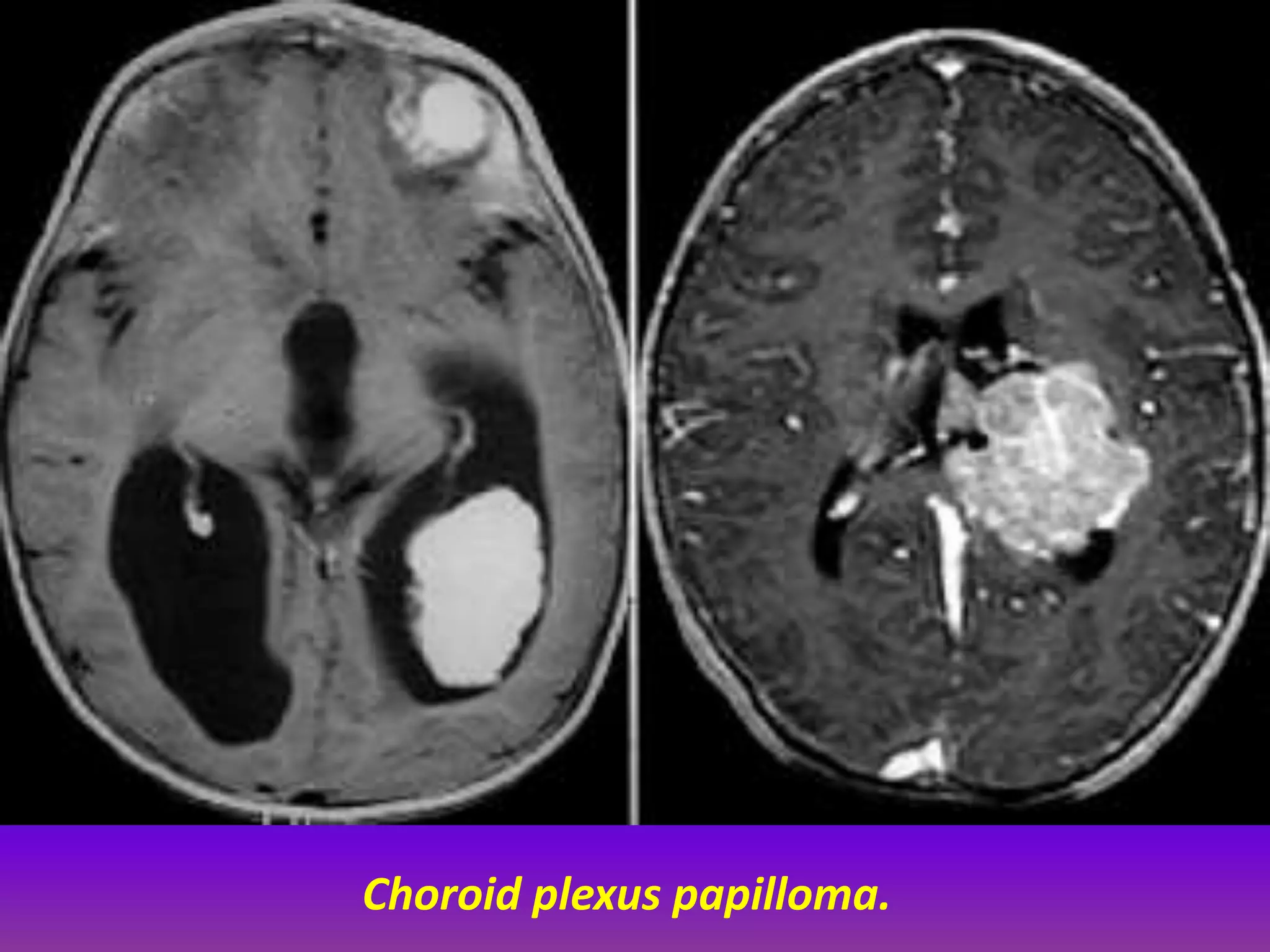 Choroid plexus papilloma. 
 