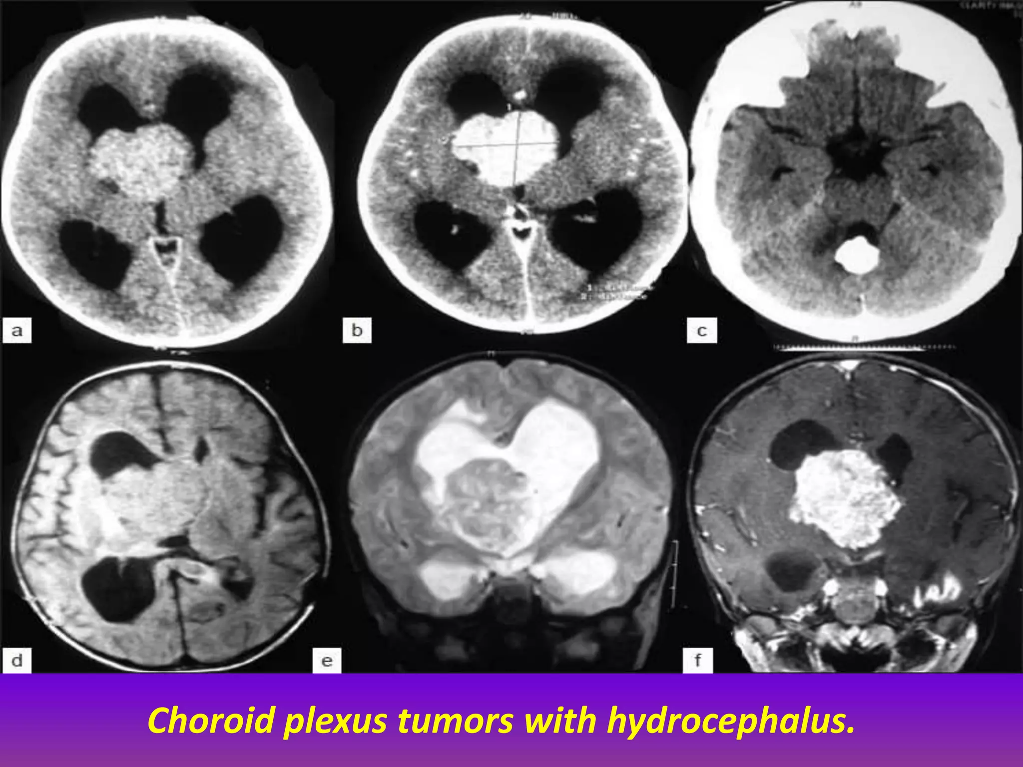 Choroid plexus tumors with hydrocephalus. 
 