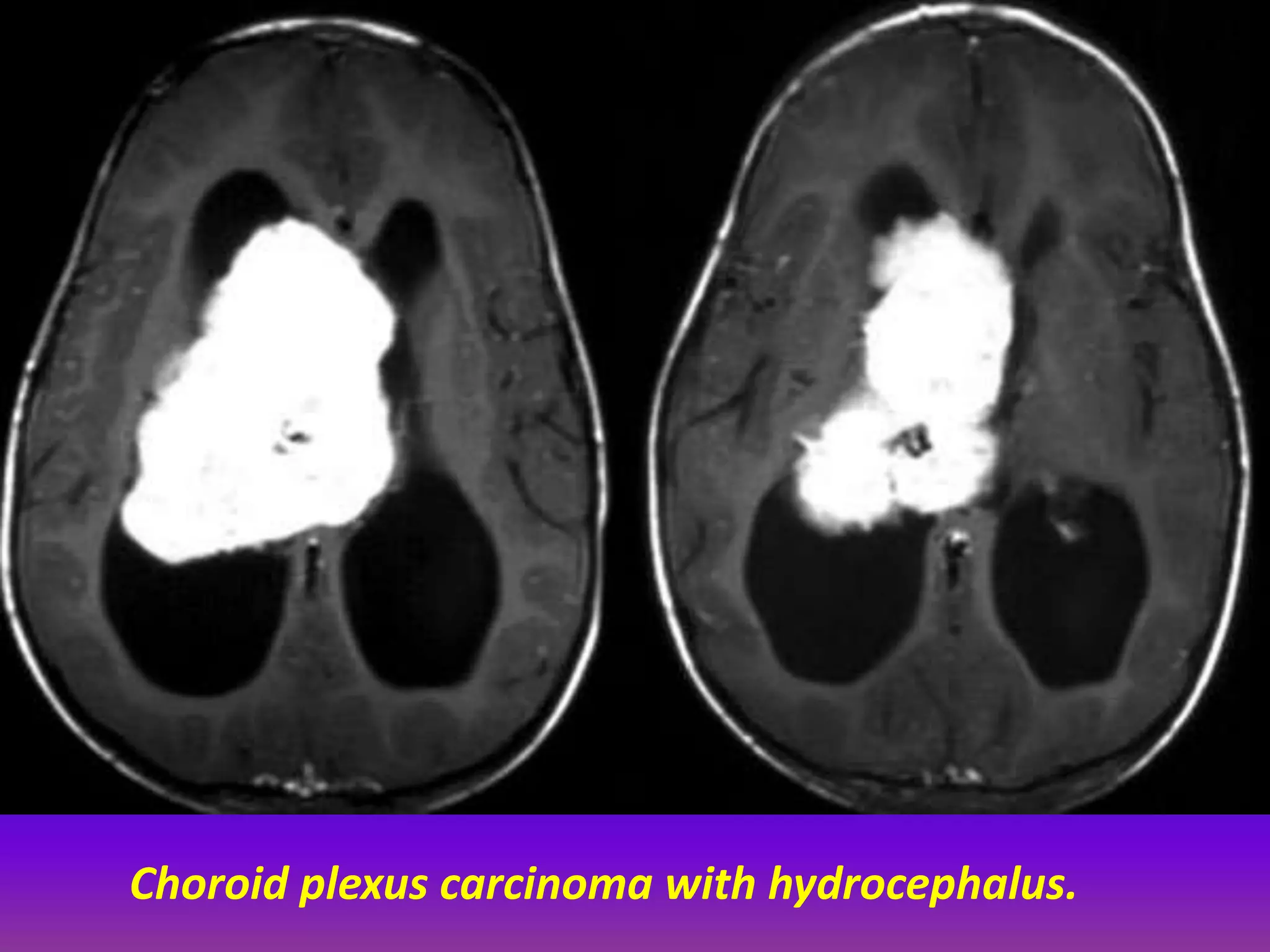Choroid plexus carcinoma with hydrocephalus. 
 