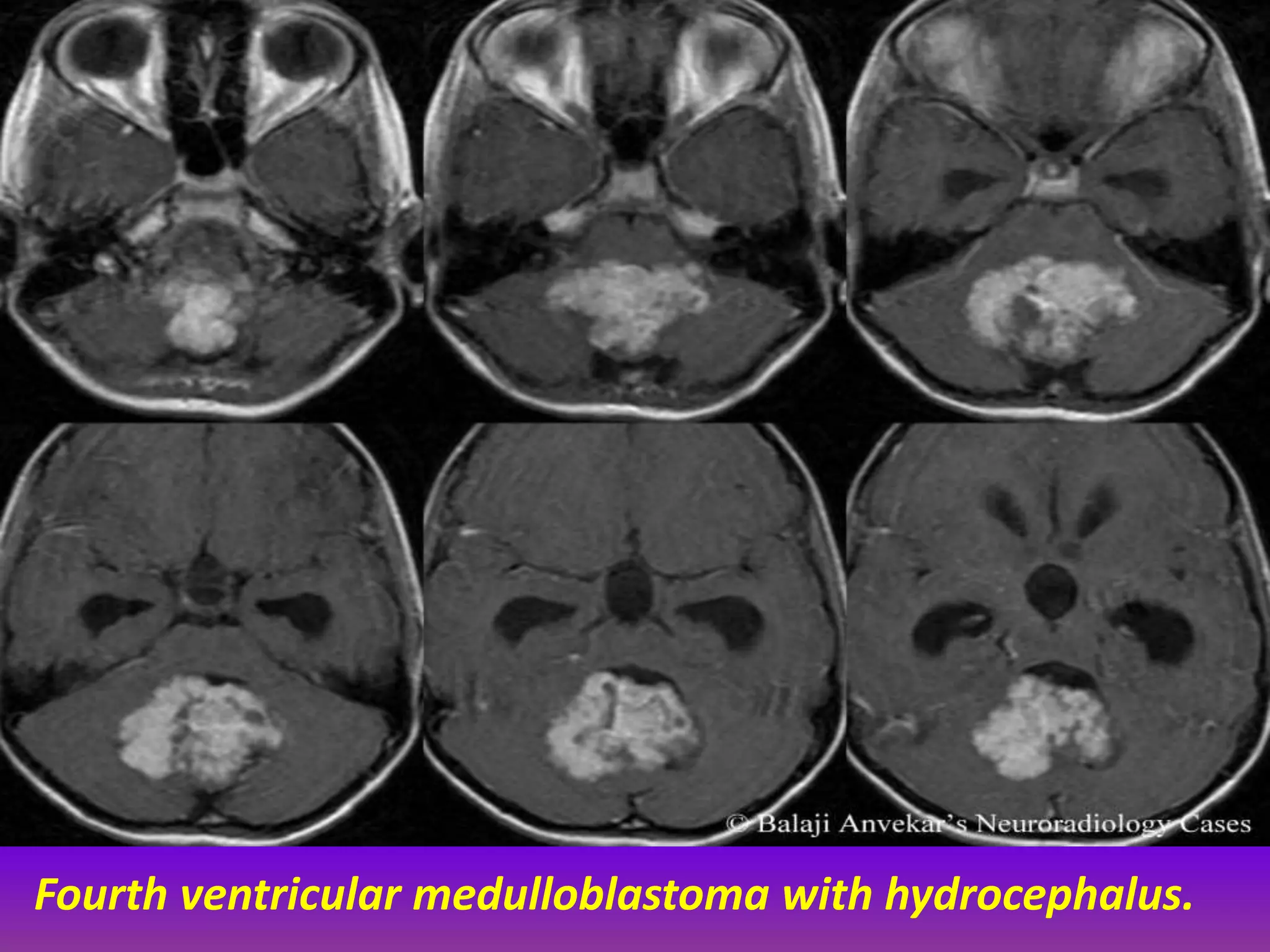 Fourth ventricular medulloblastoma with hydrocephalus. 
 