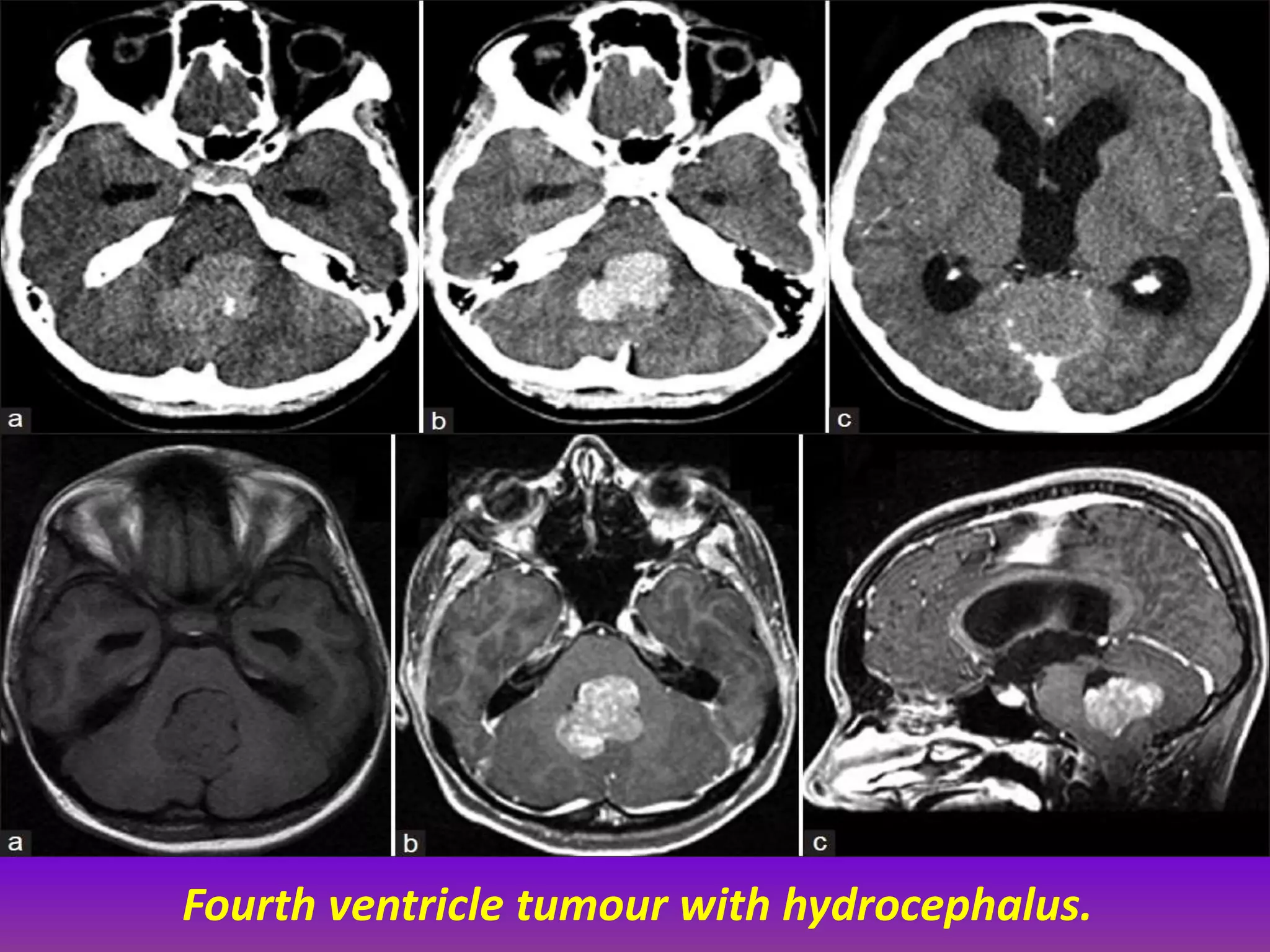 Fourth ventricle tumour with hydrocephalus. 
 