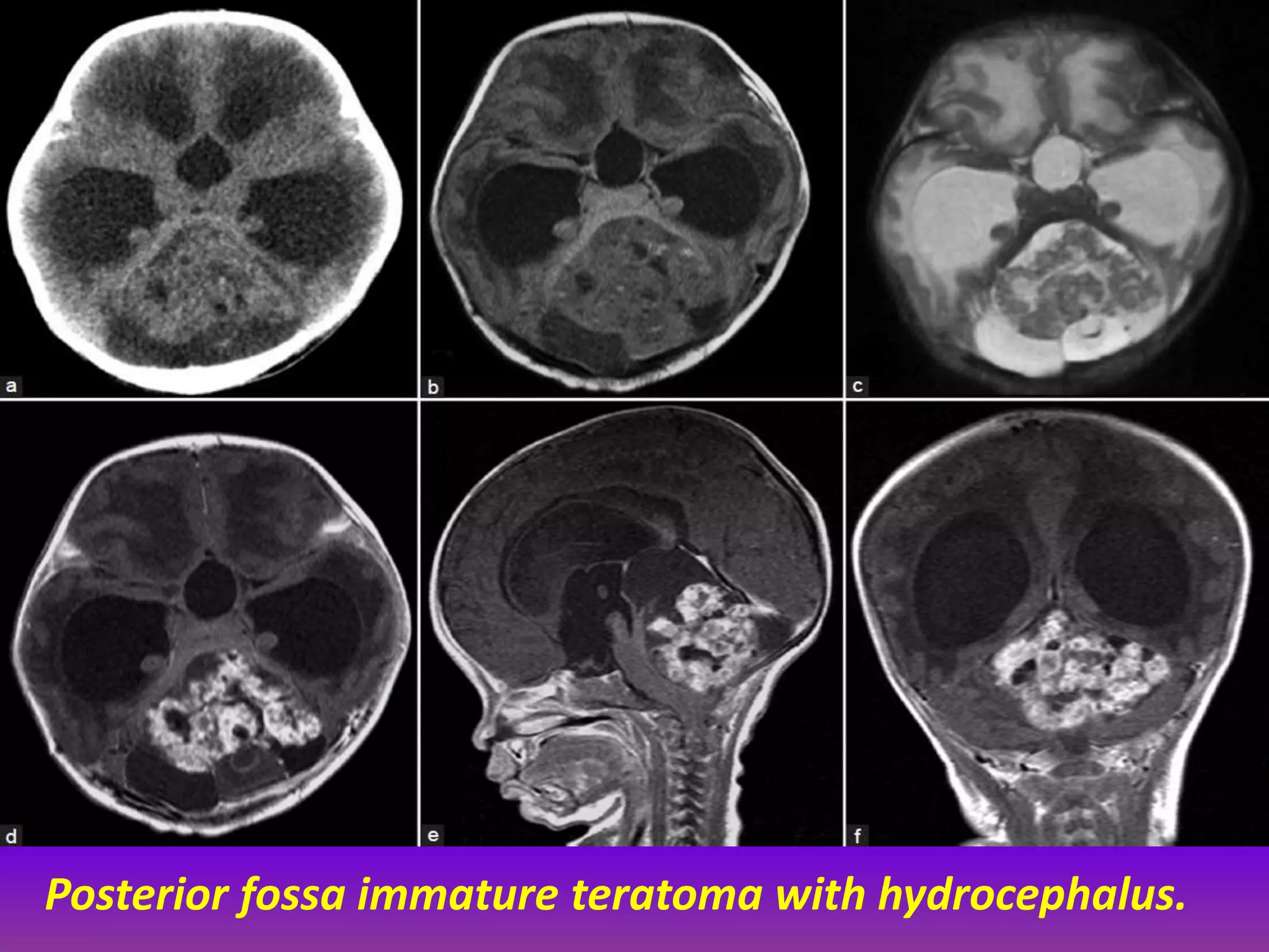 Posterior fossa immature teratoma with hydrocephalus. 
 