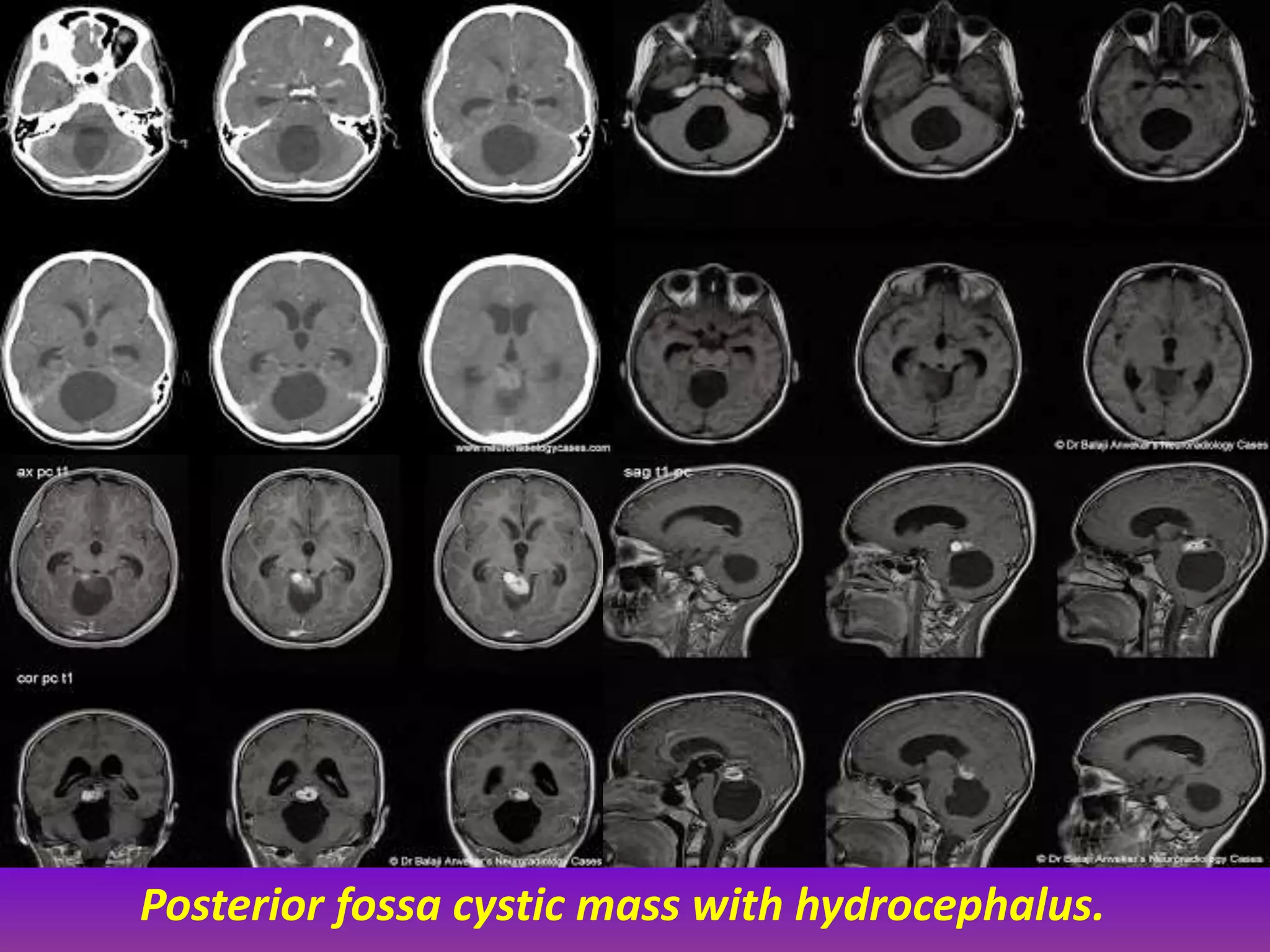 Posterior fossa cystic mass with hydrocephalus. 
 