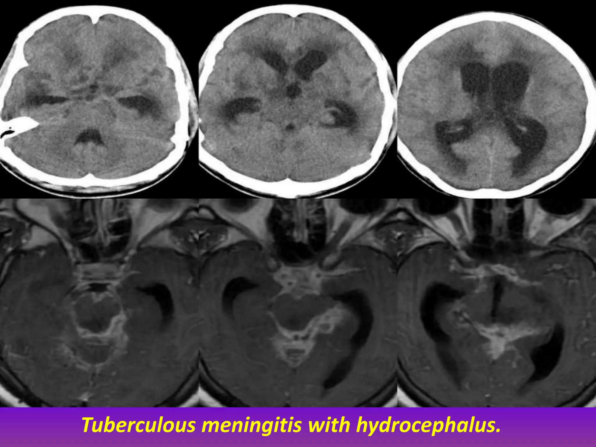 Tuberculous meningitis with hydrocephalus. 
 
