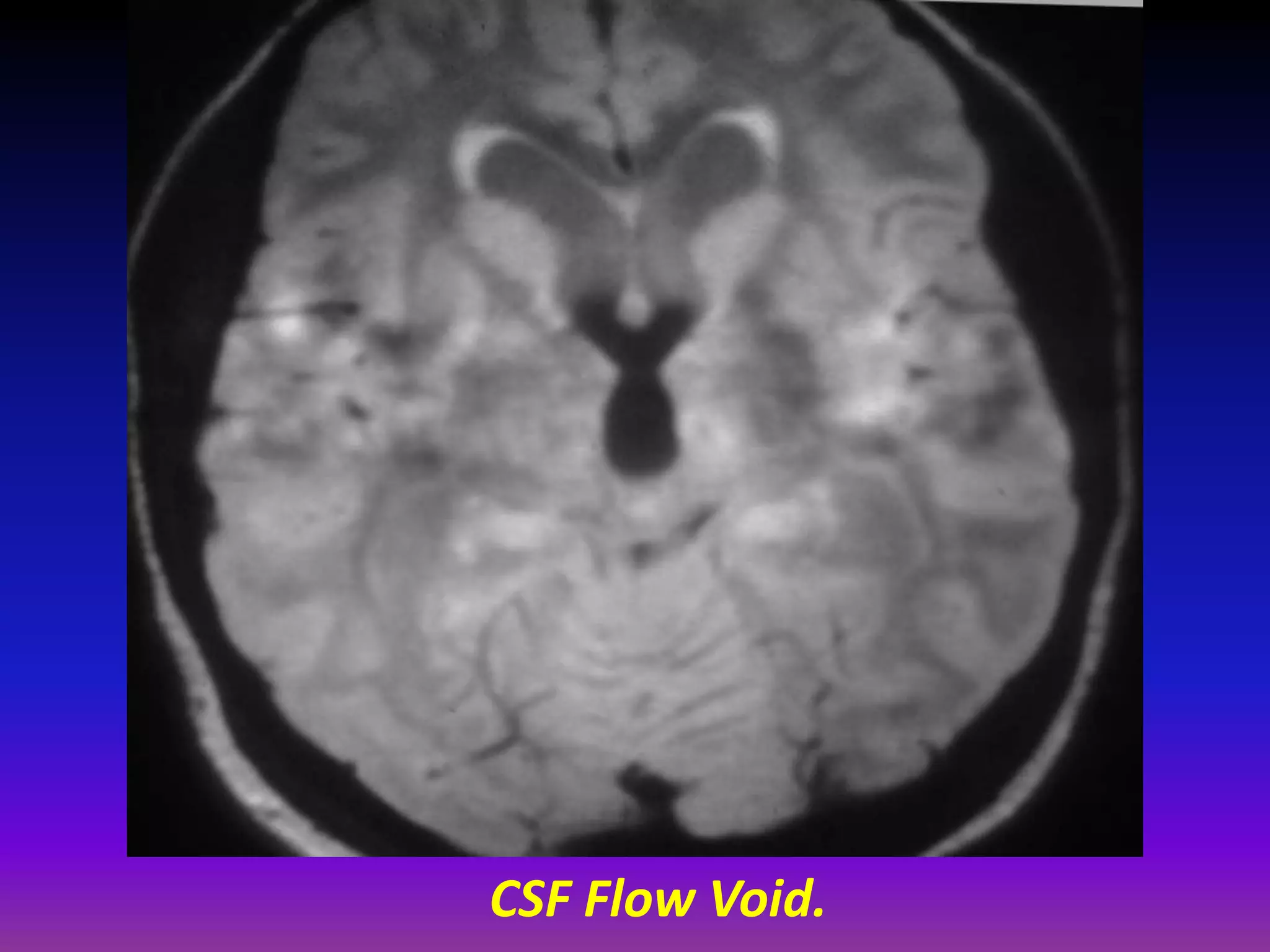 CSF Flow Void. 
 