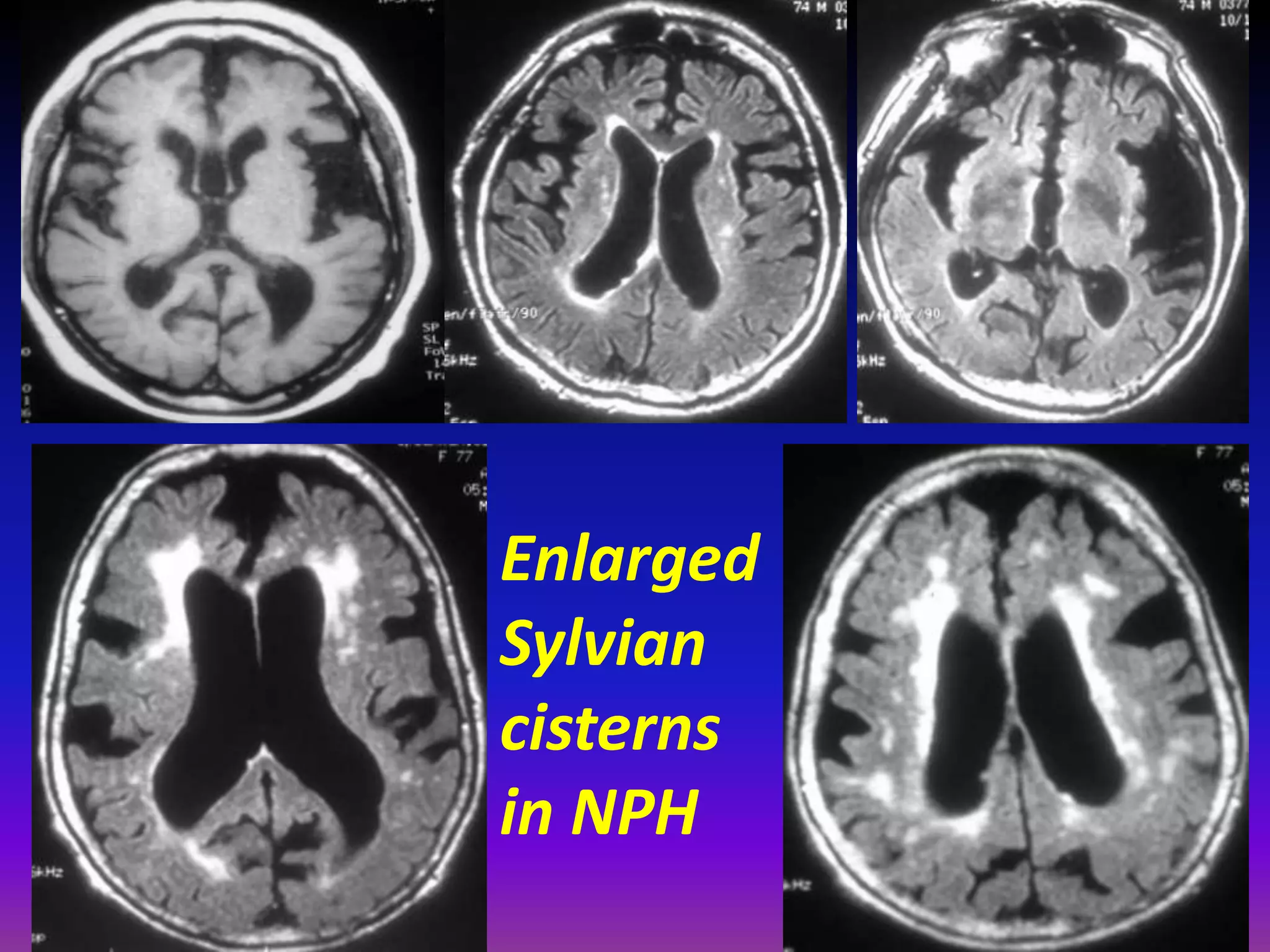 Enlarged 
Sylvian 
cisterns 
in NPH 
 