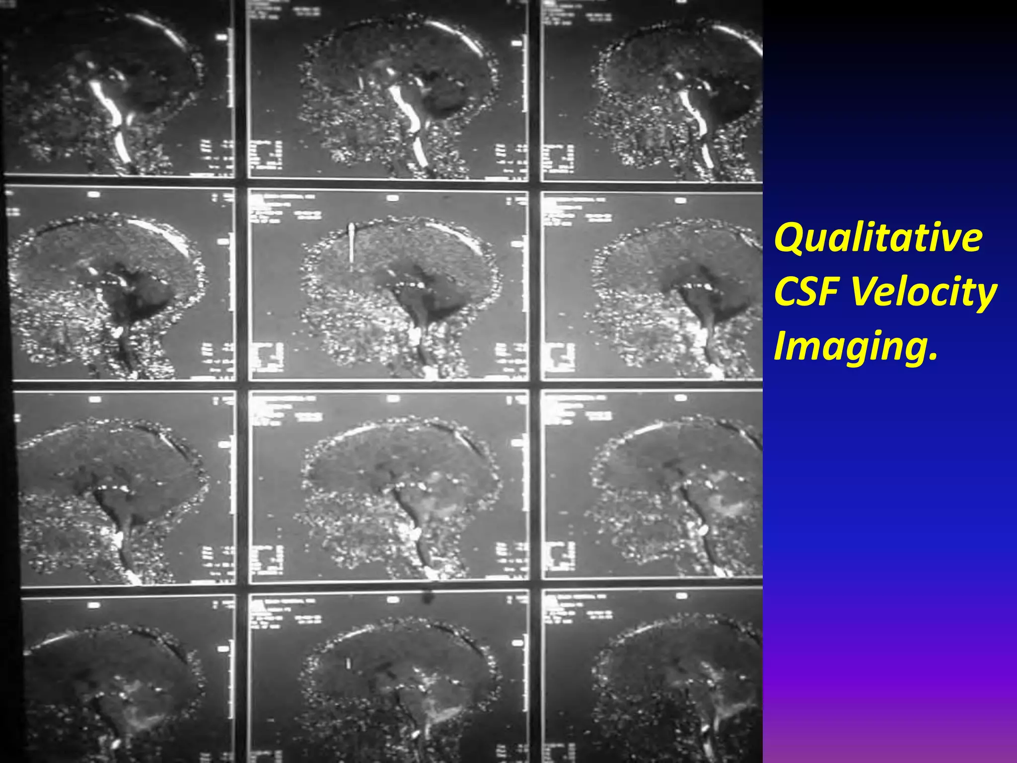 Qualitative 
CSF Velocity 
Imaging. 
 