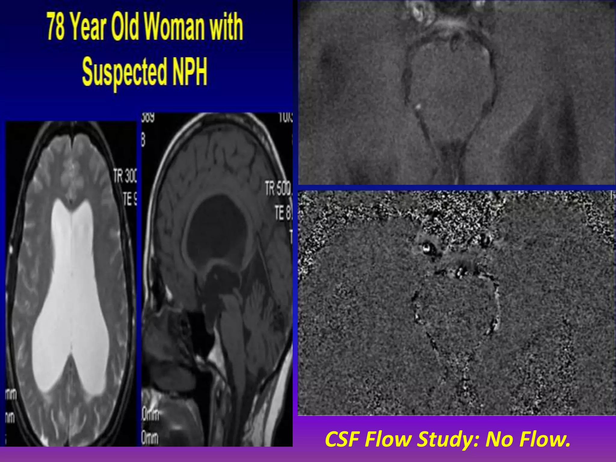 CSF Flow Study: No Flow. 
 