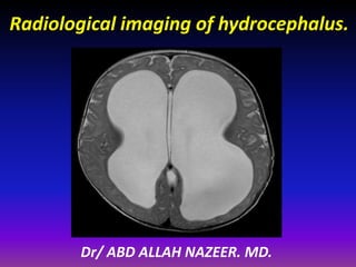Radiological imaging of hydrocephalus. 
Dr/ ABD ALLAH NAZEER. MD. 
 