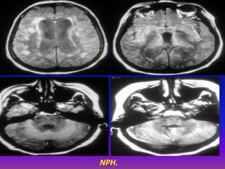 Nph Radiopaedia Presentation1.pptx, radiological imaging of hydrocephalus. | PPTX