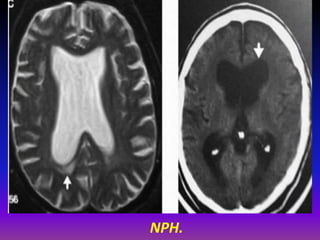 Nph Radiopaedia Presentation1.pptx, radiological imaging of hydrocephalus. | PPTX