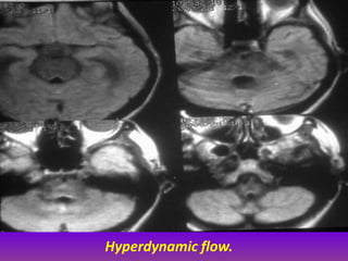 Presentation1.pptx, radiological imaging of hydrocephalus. | PPTX