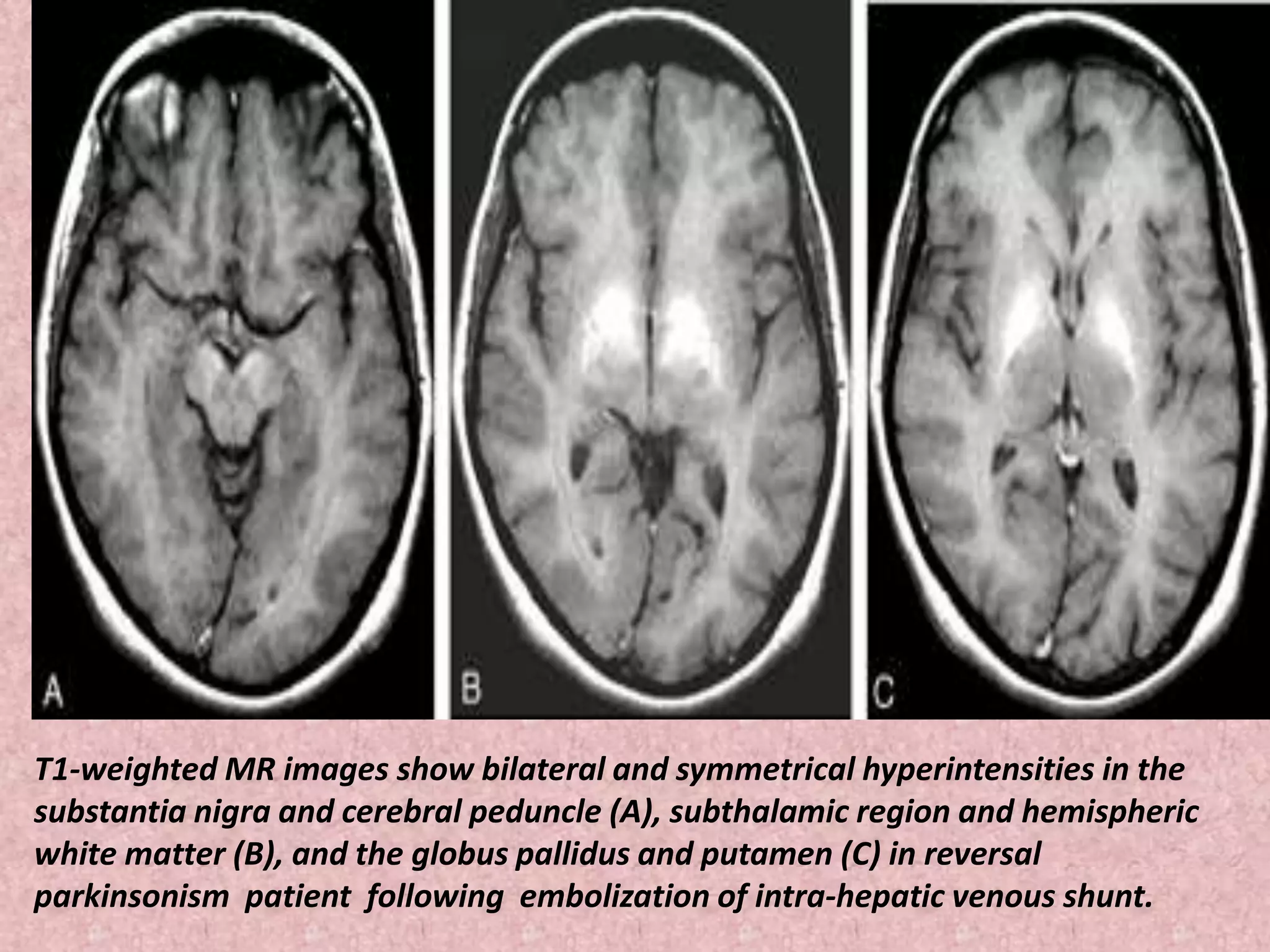 T1-weighted MR images show bilateral and symmetrical hyperintensities in the 
substantia nigra and cerebral peduncle (A), subthalamic region and hemispheric 
white matter (B), and the globus pallidus and putamen (C) in reversal 
parkinsonism patient following embolization of intra-hepatic venous shunt. 
 