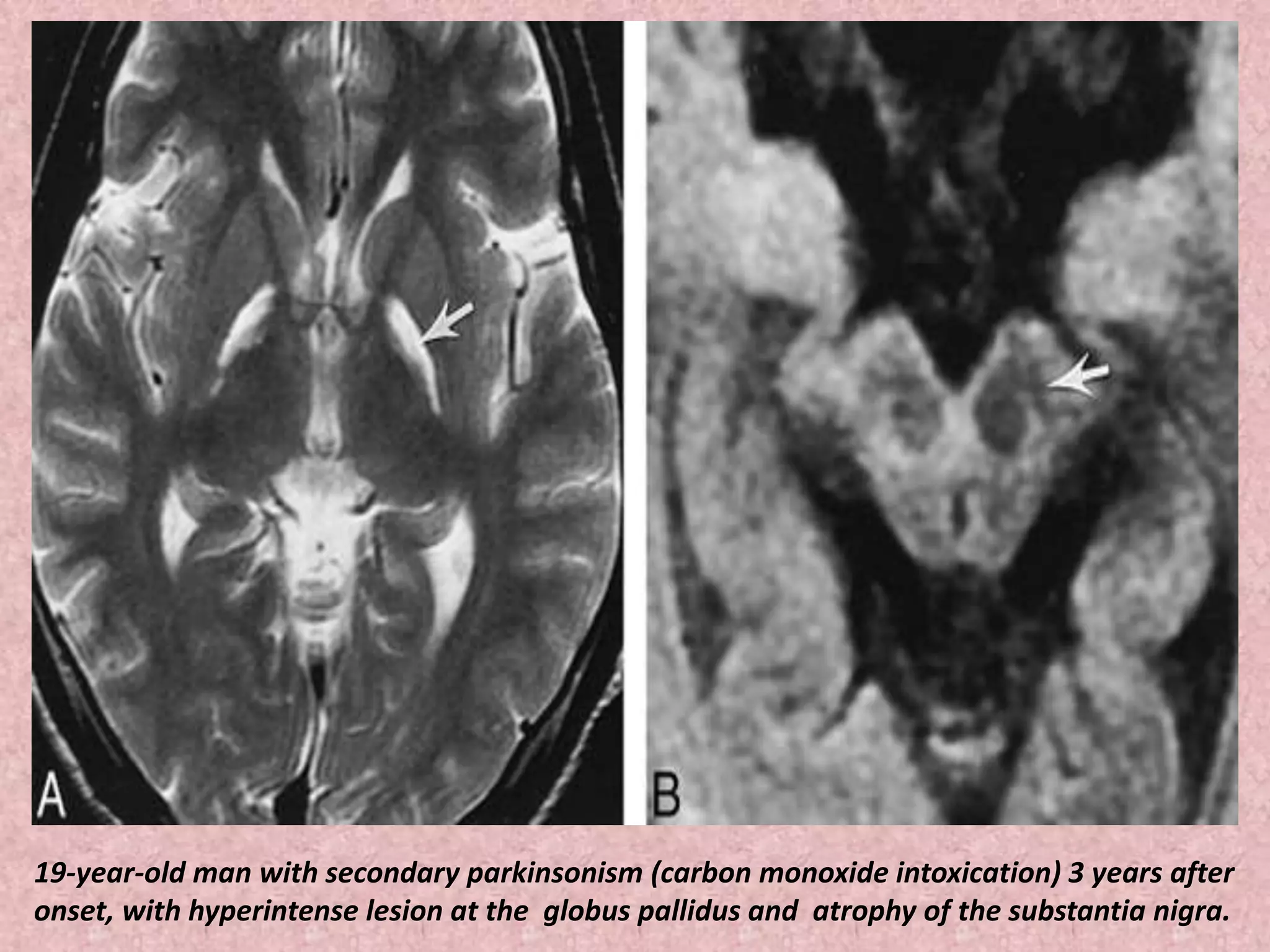 19-year-old man with secondary parkinsonism (carbon monoxide intoxication) 3 years after 
onset, with hyperintense lesion at the globus pallidus and atrophy of the substantia nigra. 
 