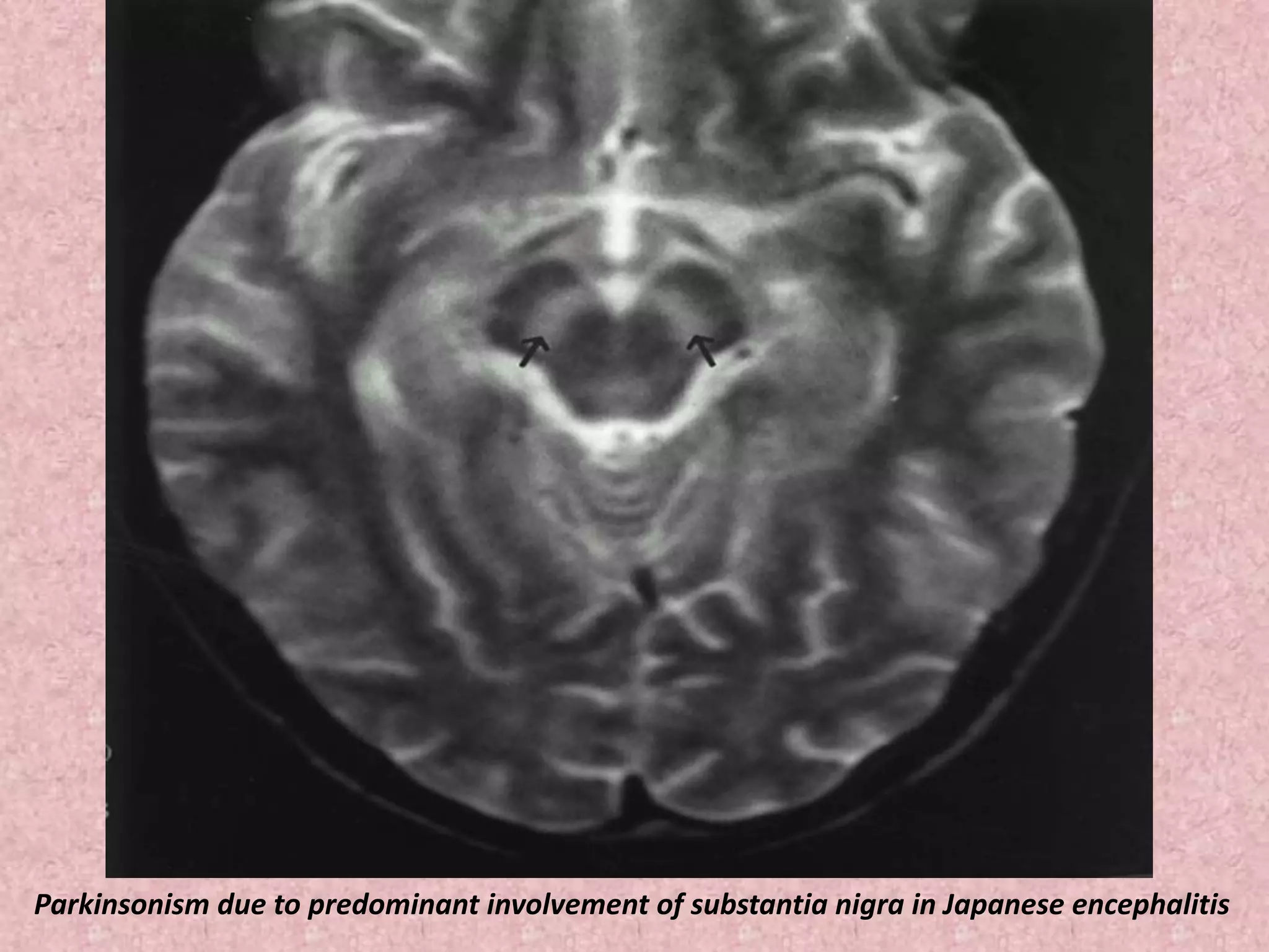 Parkinsonism due to predominant involvement of substantia nigra in Japanese encephalitis 
 