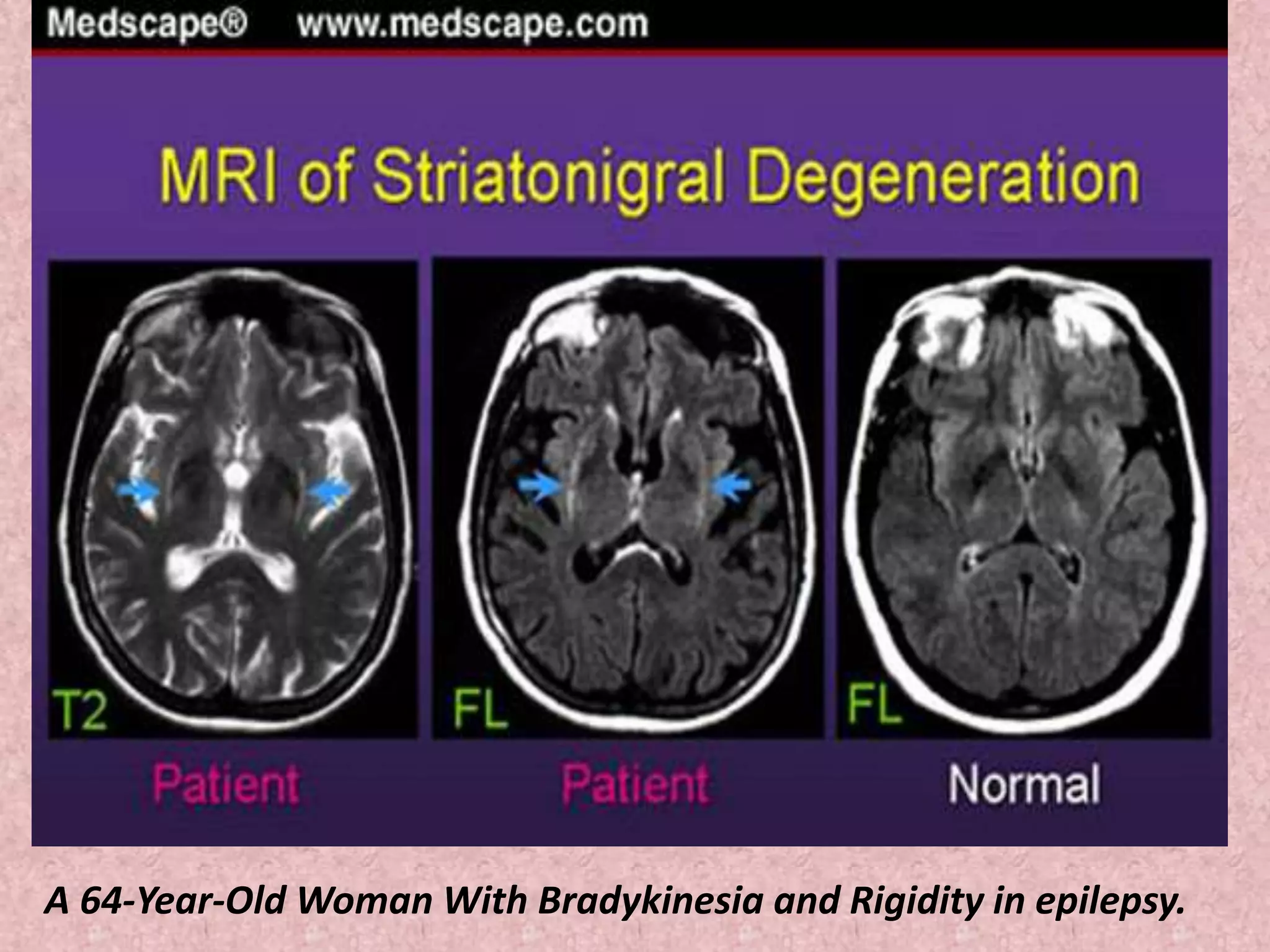 A 64-Year-Old Woman With Bradykinesia and Rigidity in epilepsy. 
 