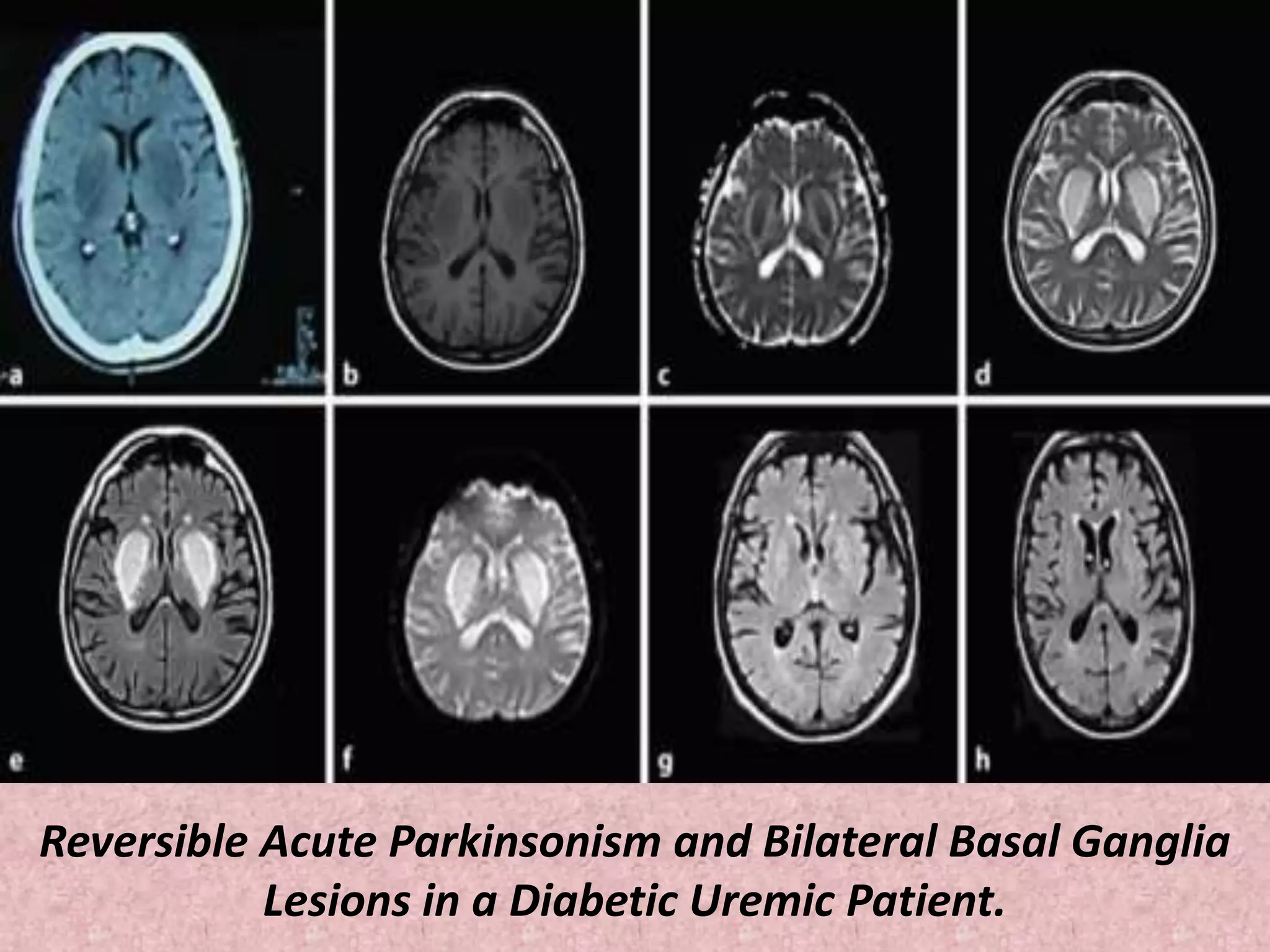 Reversible Acute Parkinsonism and Bilateral Basal Ganglia 
Lesions in a Diabetic Uremic Patient. 
 