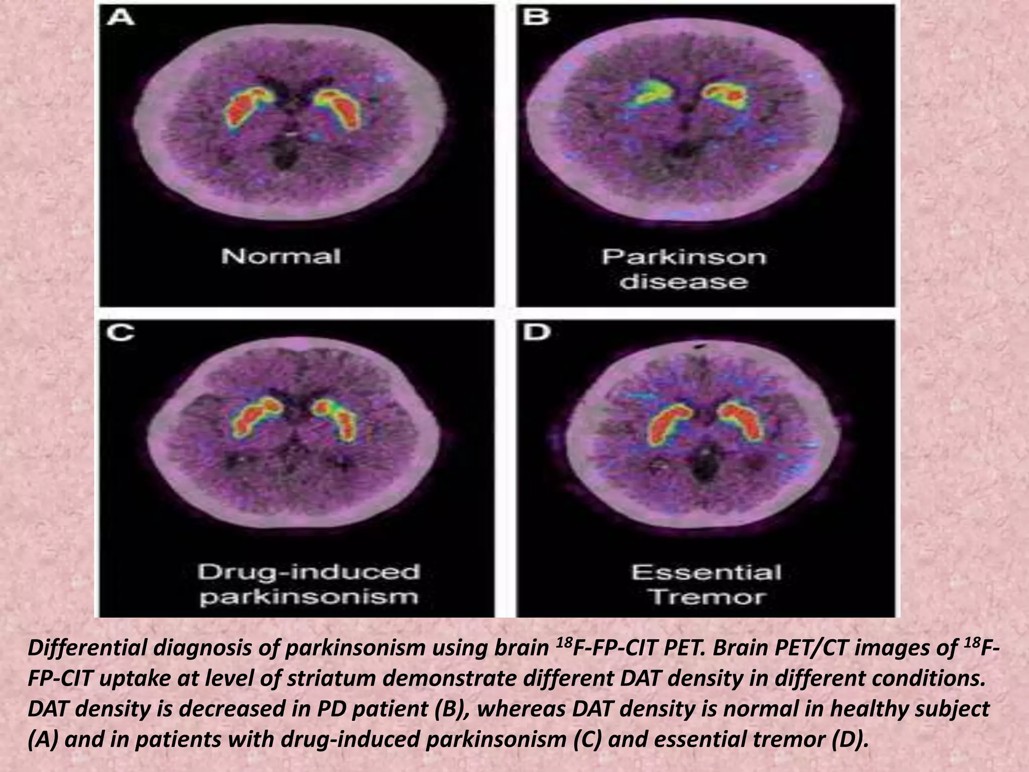 Differential diagnosis of parkinsonism using brain 18F-FP-CIT PET. Brain PET/CT images of 18F-FP- 
CIT uptake at level of striatum demonstrate different DAT density in different conditions. 
DAT density is decreased in PD patient (B), whereas DAT density is normal in healthy subject 
(A) and in patients with drug-induced parkinsonism (C) and essential tremor (D). 
 