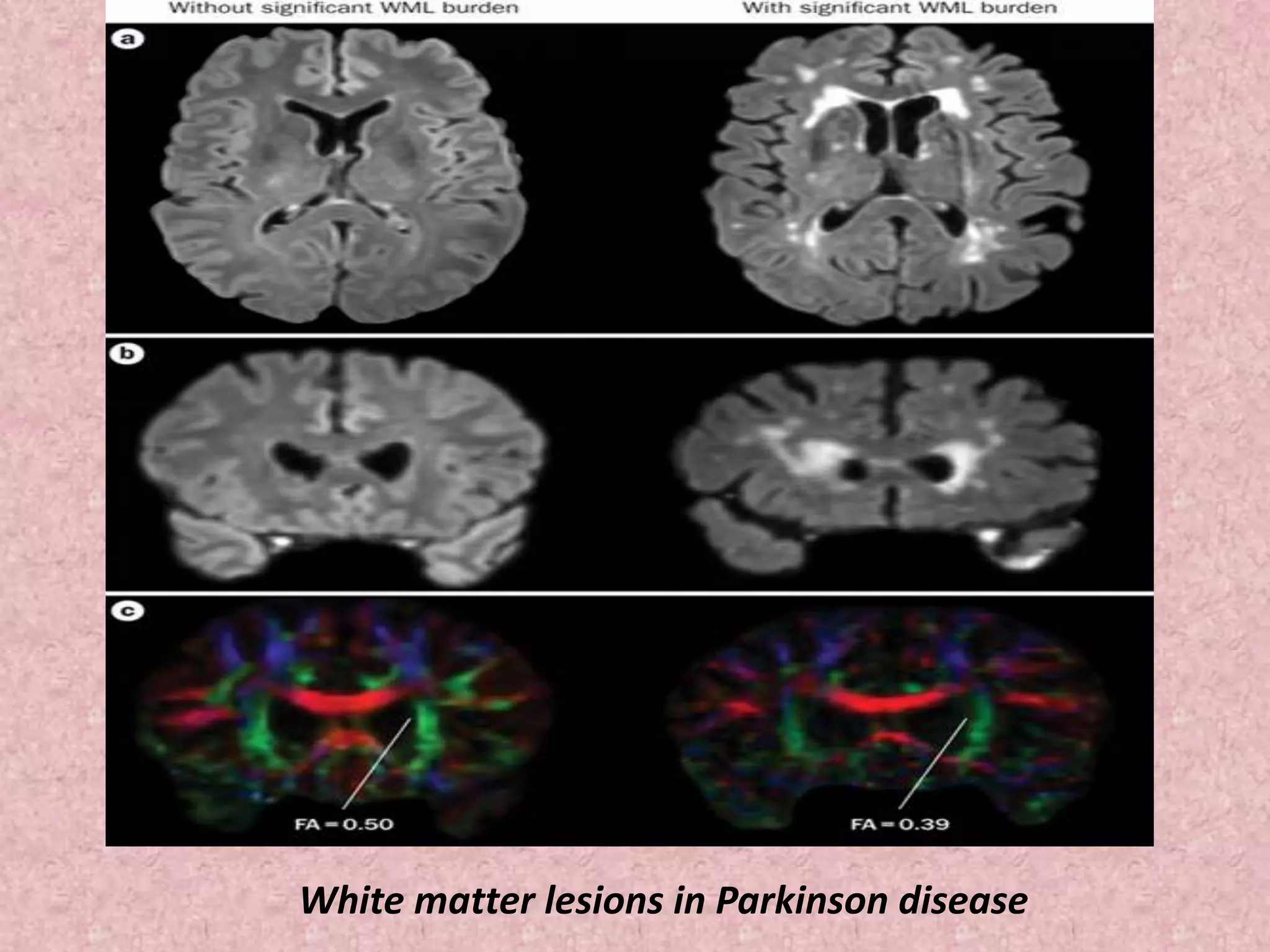 White matter lesions in Parkinson disease 
 