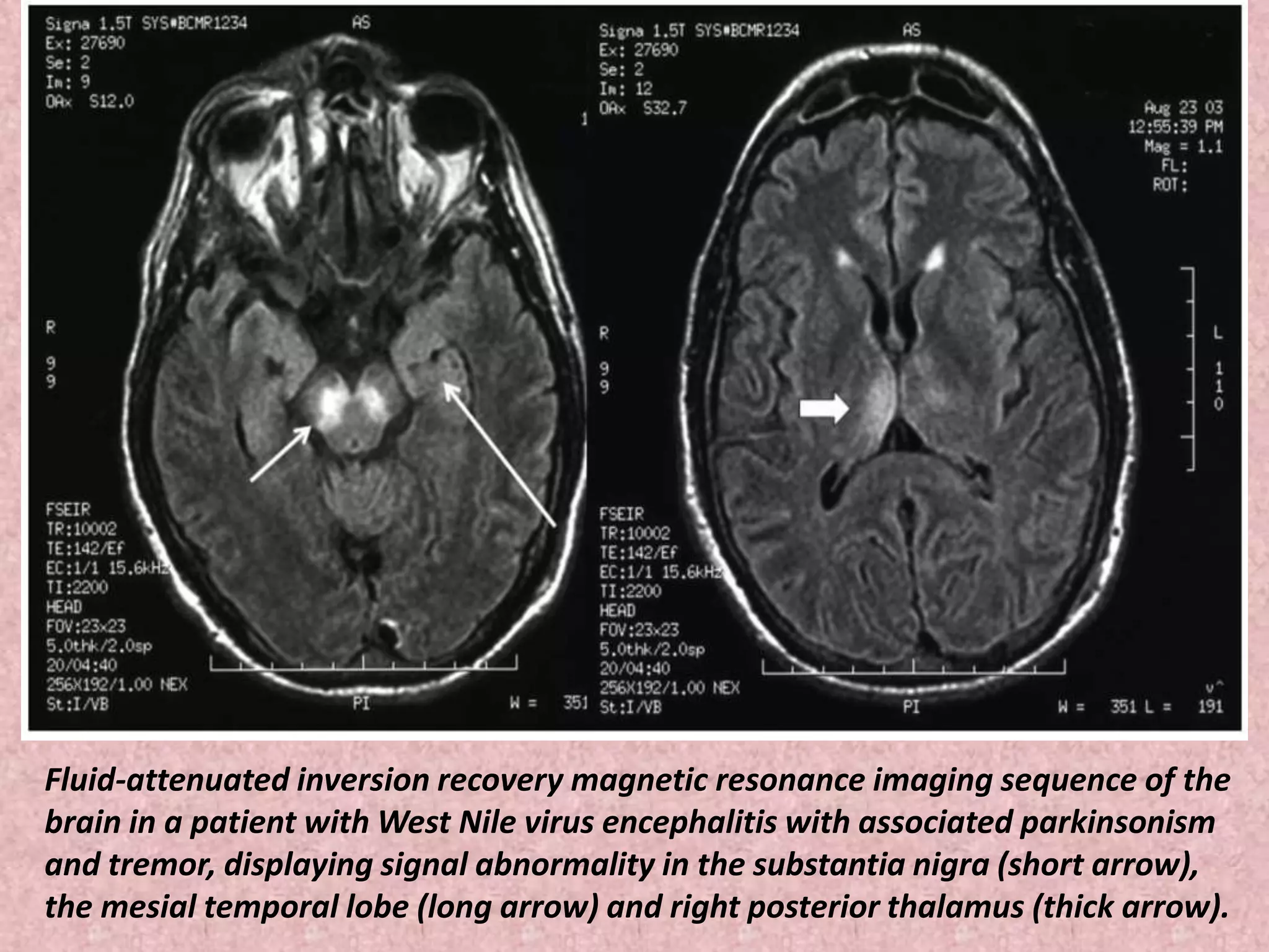 Fluid-attenuated inversion recovery magnetic resonance imaging sequence of the 
brain in a patient with West Nile virus encephalitis with associated parkinsonism 
and tremor, displaying signal abnormality in the substantia nigra (short arrow), 
the mesial temporal lobe (long arrow) and right posterior thalamus (thick arrow). 
 
