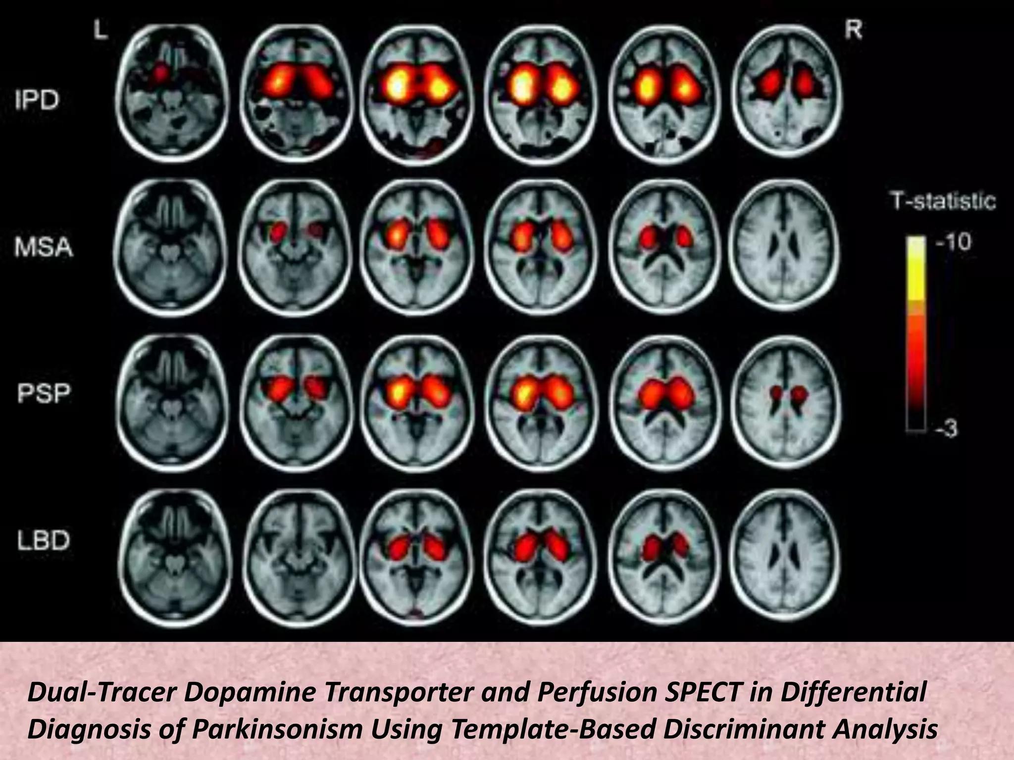 Dual-Tracer Dopamine Transporter and Perfusion SPECT in Differential 
Diagnosis of Parkinsonism Using Template-Based Discriminant Analysis 
 