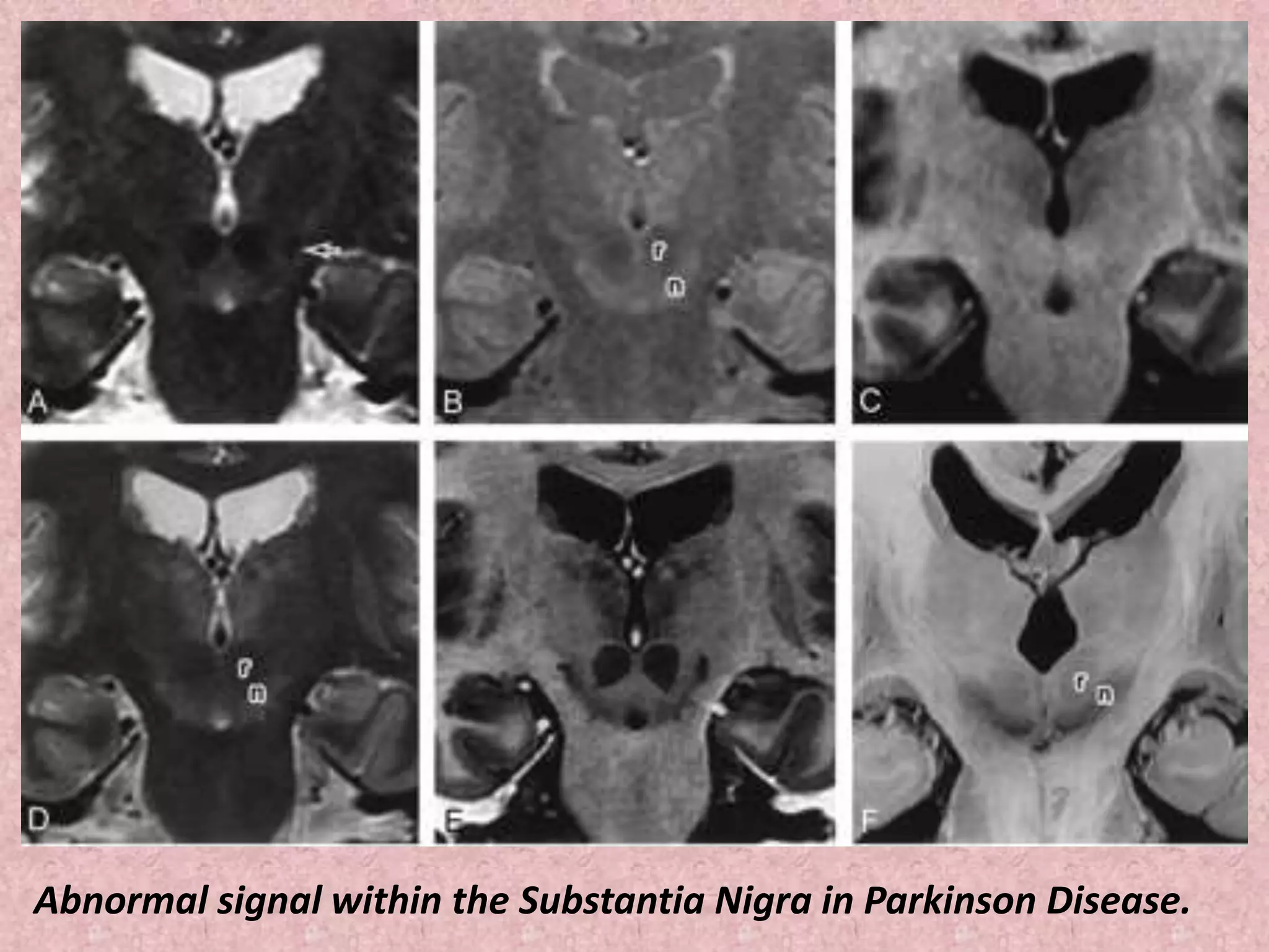 Abnormal signal within the Substantia Nigra in Parkinson Disease. 
 