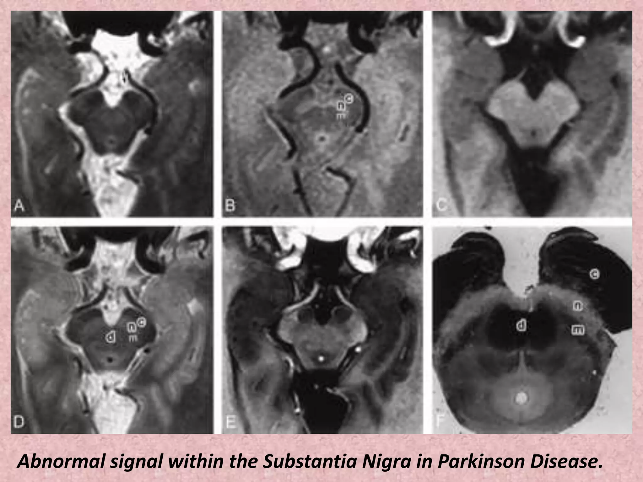 Abnormal signal within the Substantia Nigra in Parkinson Disease. 
 