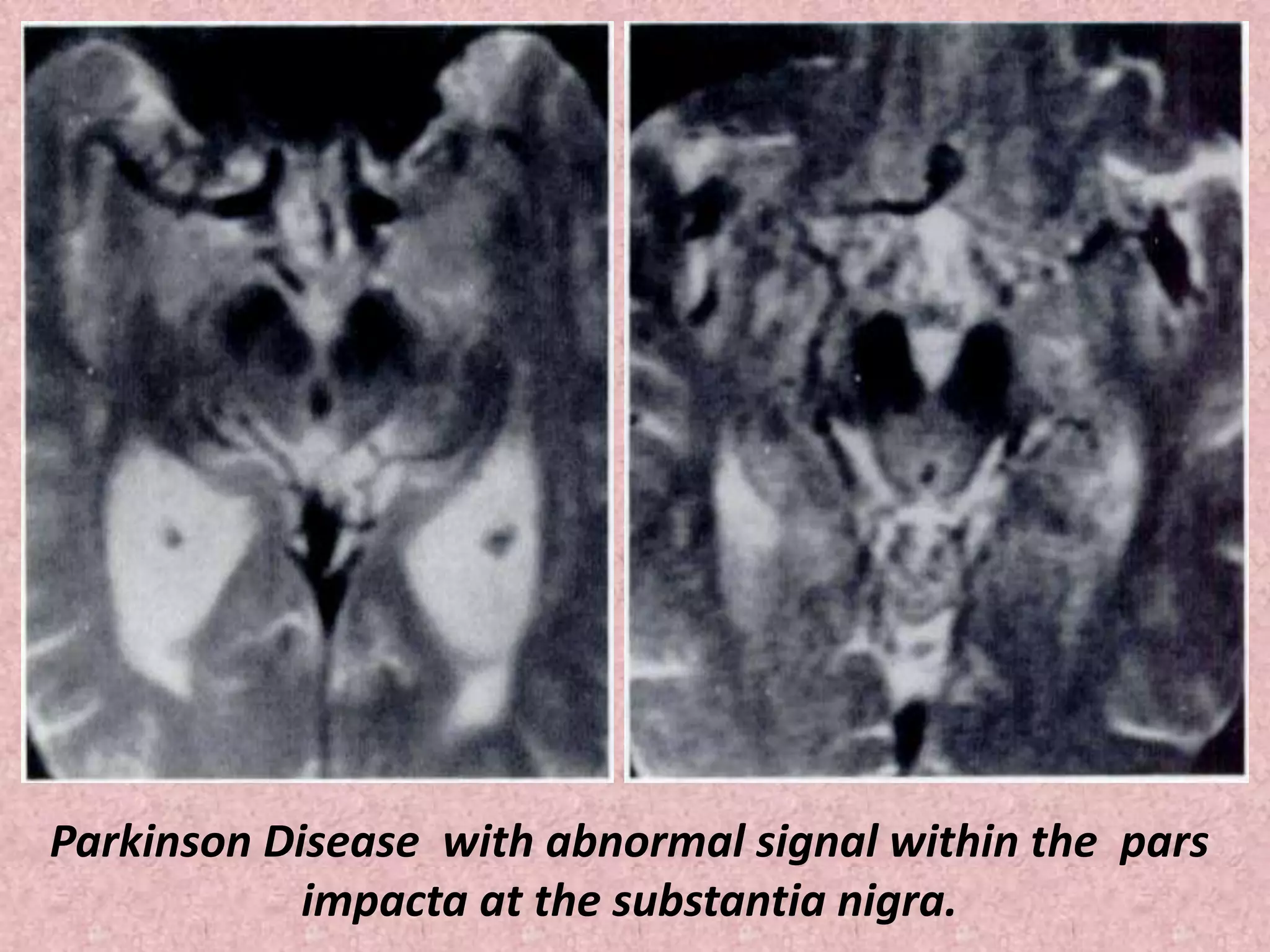Parkinson Disease with abnormal signal within the pars 
impacta at the substantia nigra. 
 