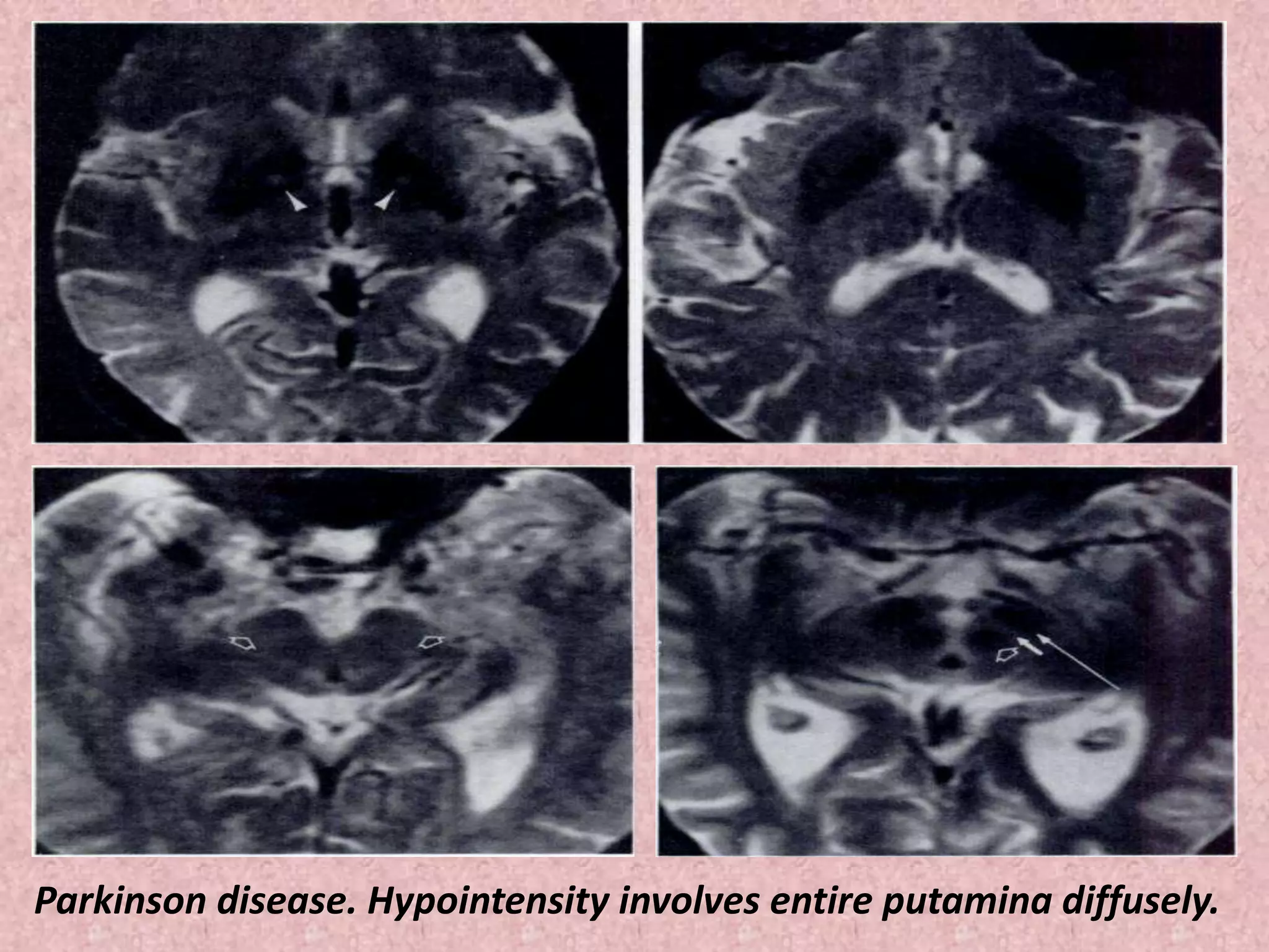 Parkinson disease. Hypointensity involves entire putamina diffusely. 
 