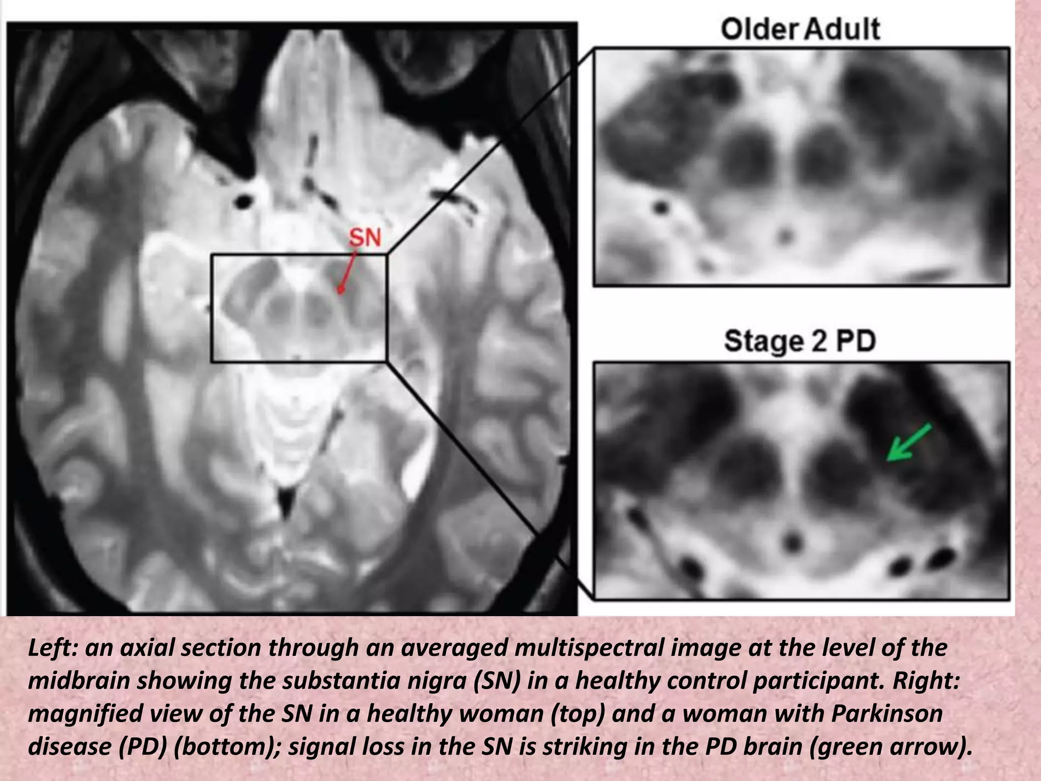 Left: an axial section through an averaged multispectral image at the level of the 
midbrain showing the substantia nigra (SN) in a healthy control participant. Right: 
magnified view of the SN in a healthy woman (top) and a woman with Parkinson 
disease (PD) (bottom); signal loss in the SN is striking in the PD brain (green arrow). 
 