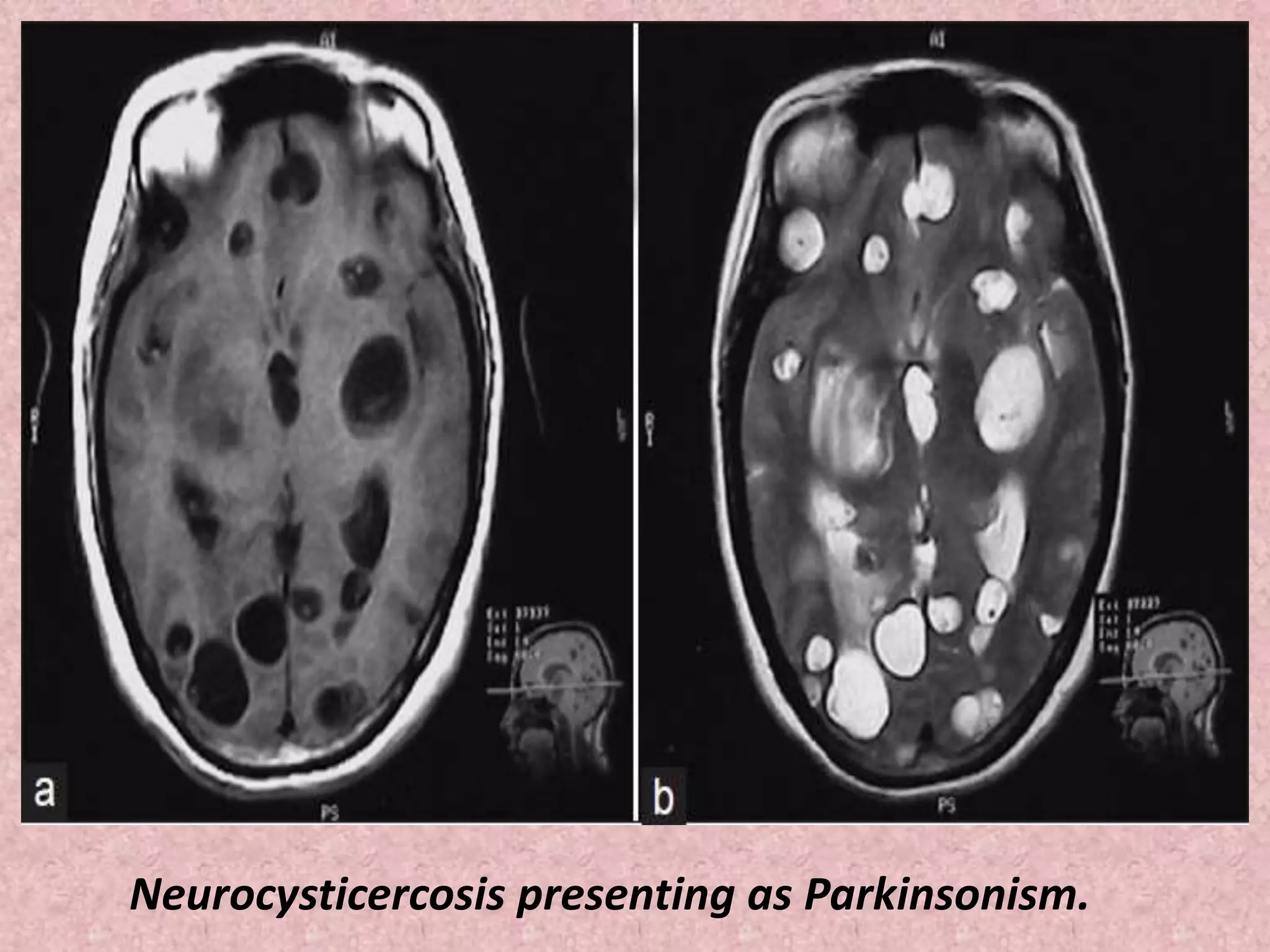 Neurocysticercosis presenting as Parkinsonism. 
 