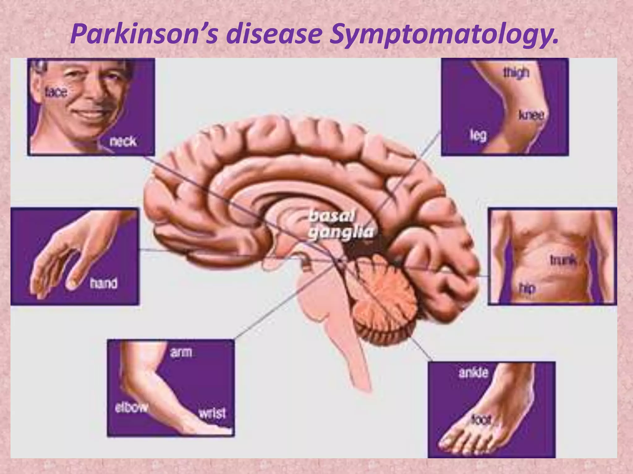 Parkinson’s disease Symptomatology. 
 