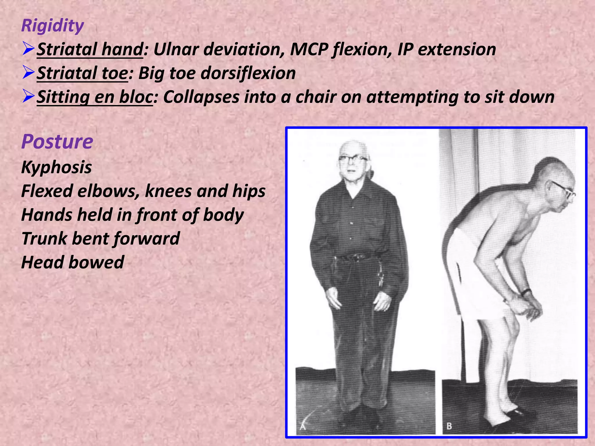 Rigidity 
Striatal hand: Ulnar deviation, MCP flexion, IP extension 
Striatal toe: Big toe dorsiflexion 
Sitting en bloc: Collapses into a chair on attempting to sit down 
Posture 
Kyphosis 
Flexed elbows, knees and hips 
Hands held in front of body 
Trunk bent forward 
Head bowed 
 