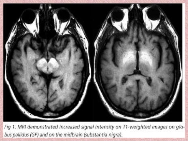 Presentation1 Pptx Radiological Imaging Of Parkinsonism