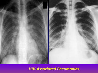 Pericardial Effusion 
The prevalence of pericardial effusion in asymptomatic AIDS patients has 
been estimated at 11% befo...