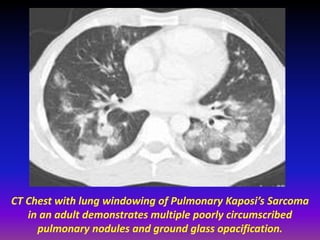 AIDS with gastric lymphoma with circumferential wall thickening. 
 
