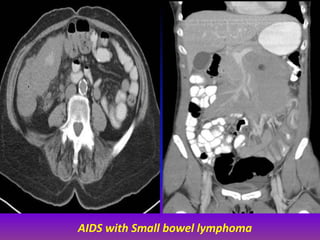 Splenic KS in a 50-year-old HIV-positive man. Abdominal CT scan 
shows multiple subcentimeter hypoattenuating nodules in t...