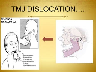 TMJ DISLOCATION…. 
 