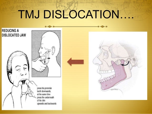 Subluxations facial tics Youth fist kung fu