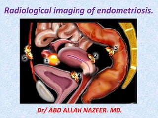 Radiological imaging of endometriosis.
Dr/ ABD ALLAH NAZEER. MD.
 